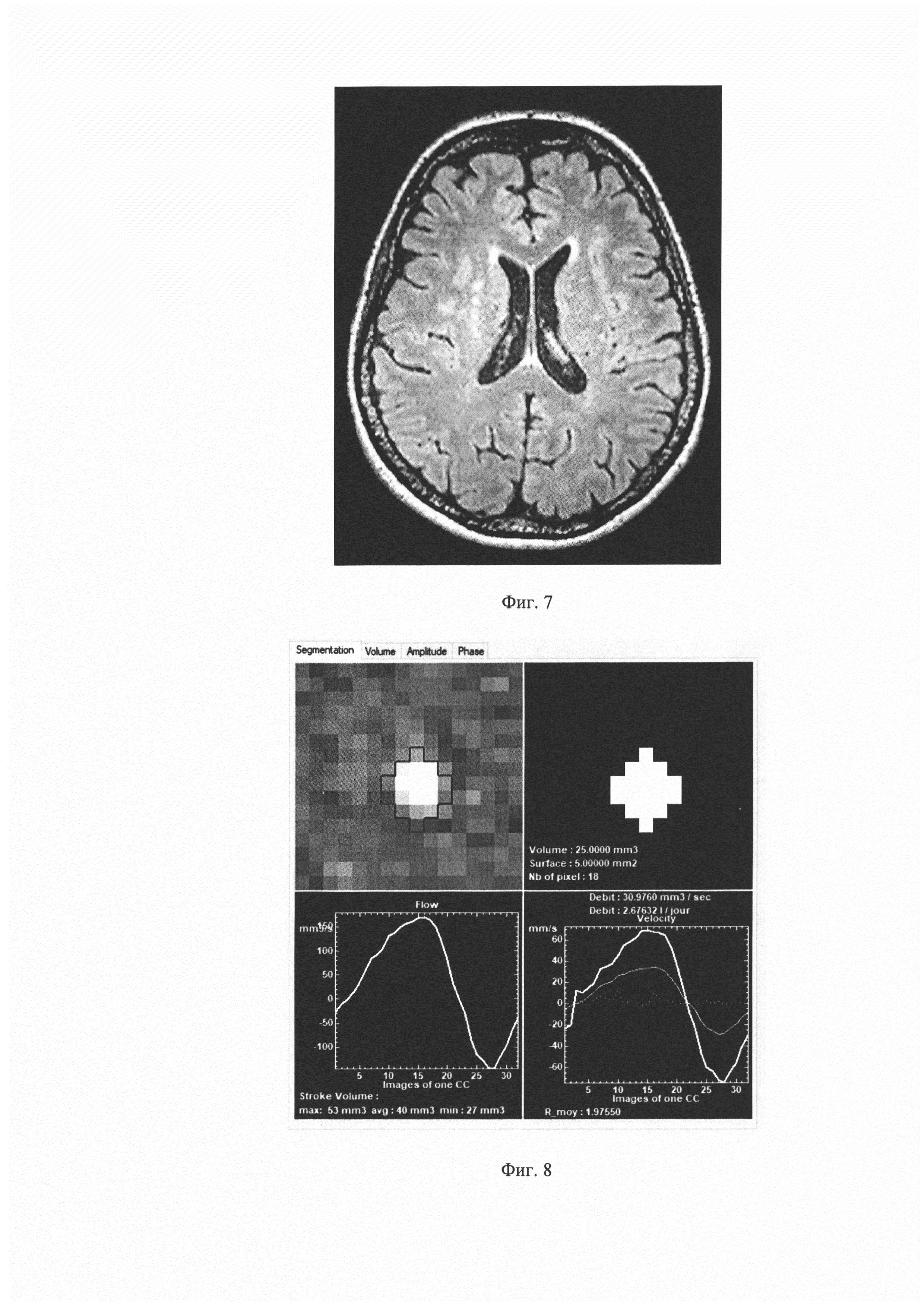 Способ оценки участия нарушенной ликвородинамики в развитии диффузного поражения белого вещества головного мозга при церебральной микроангиопатии