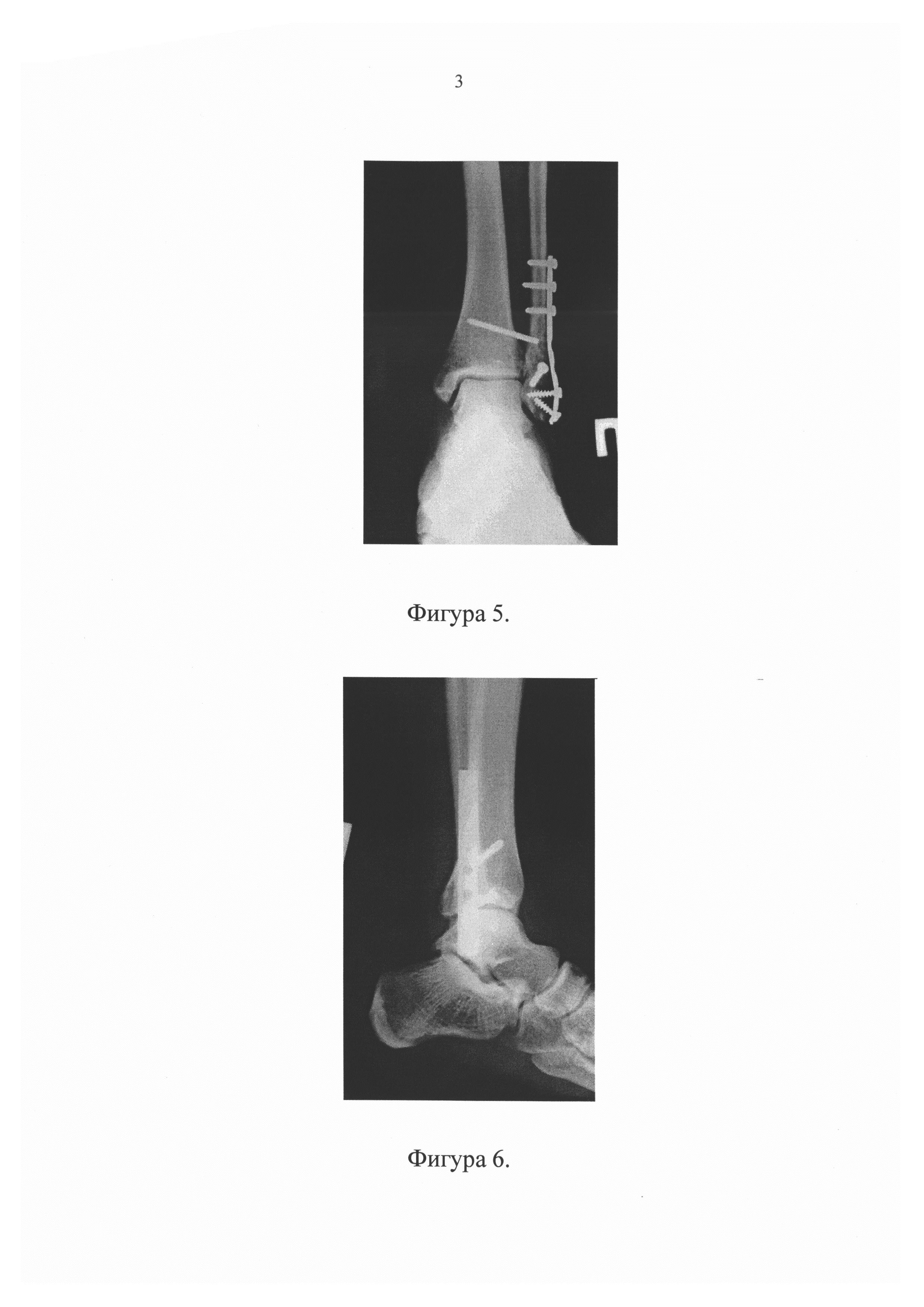 Реферат: Переломы лодыжек, повреждения голеностопного сустава