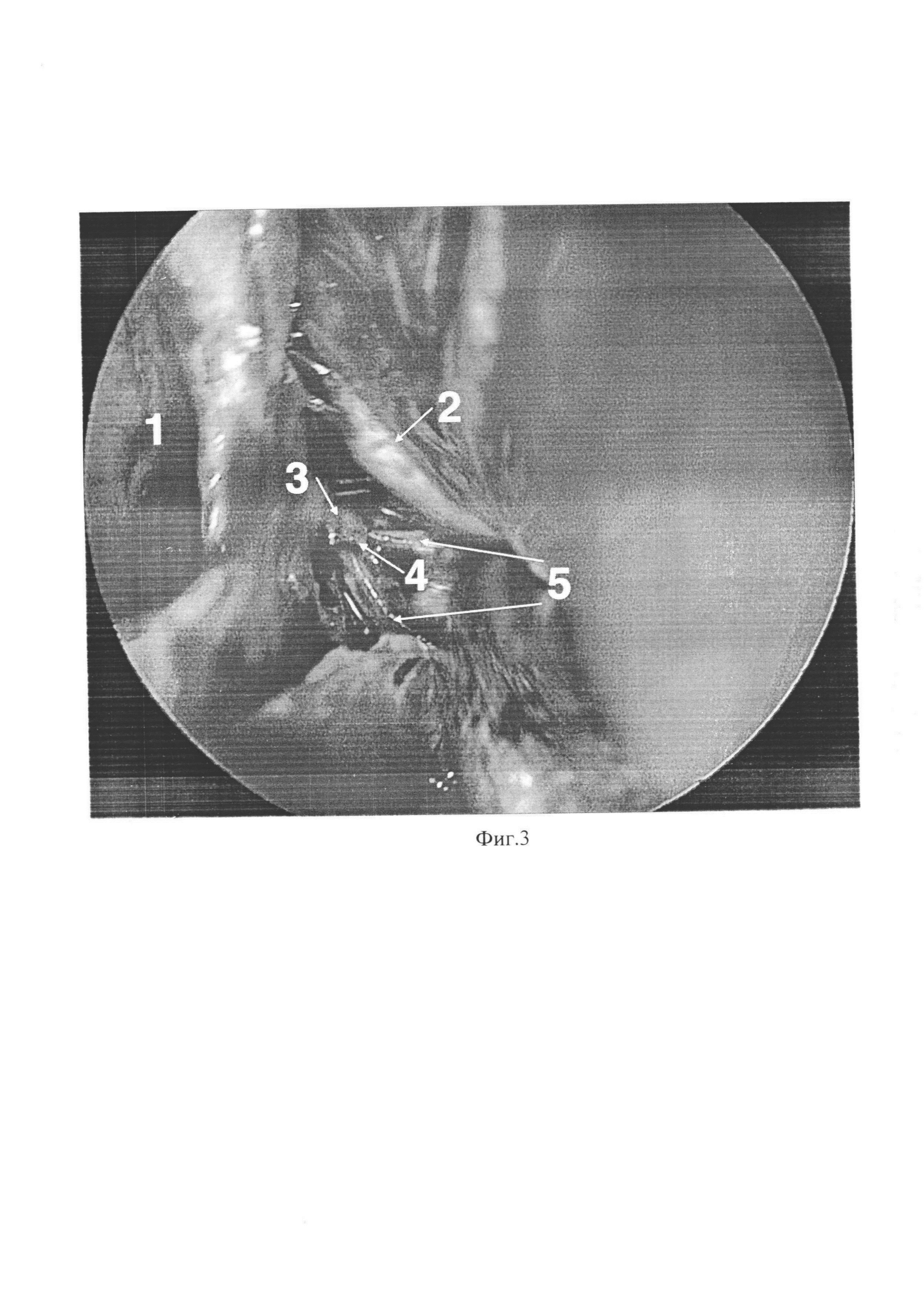 Способ улучшения визуализации хирургического поля во время эндоскопической эндоназальной операции у пациентов с полипозным риносинуситом