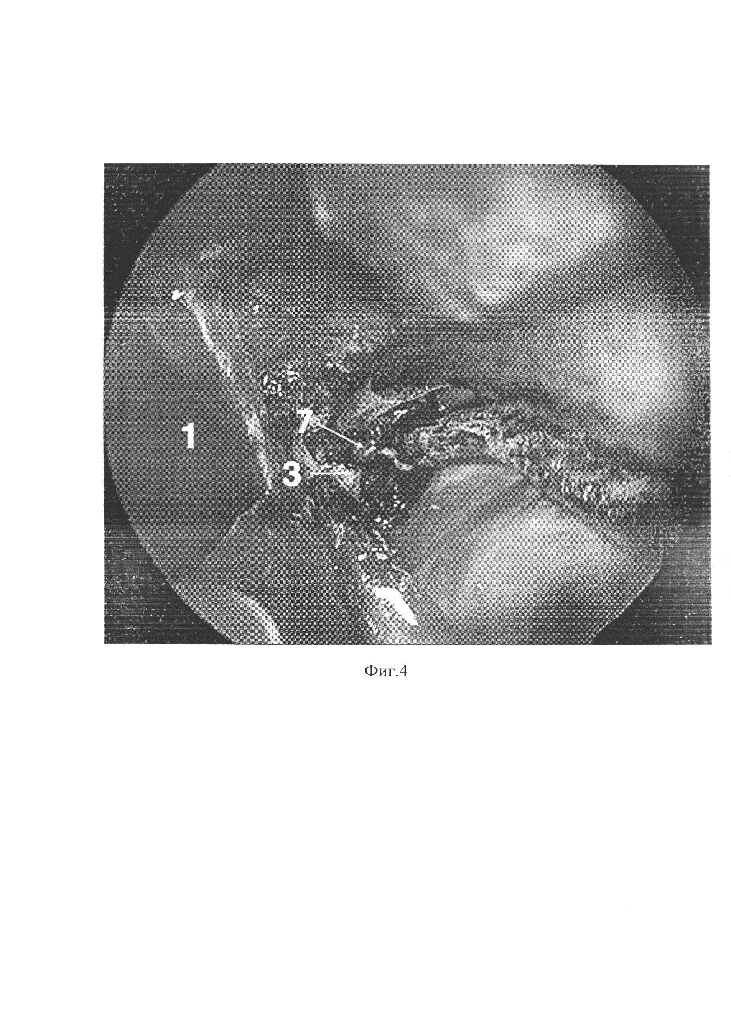 Способ улучшения визуализации хирургического поля во время эндоскопической эндоназальной операции у пациентов с полипозным риносинуситом