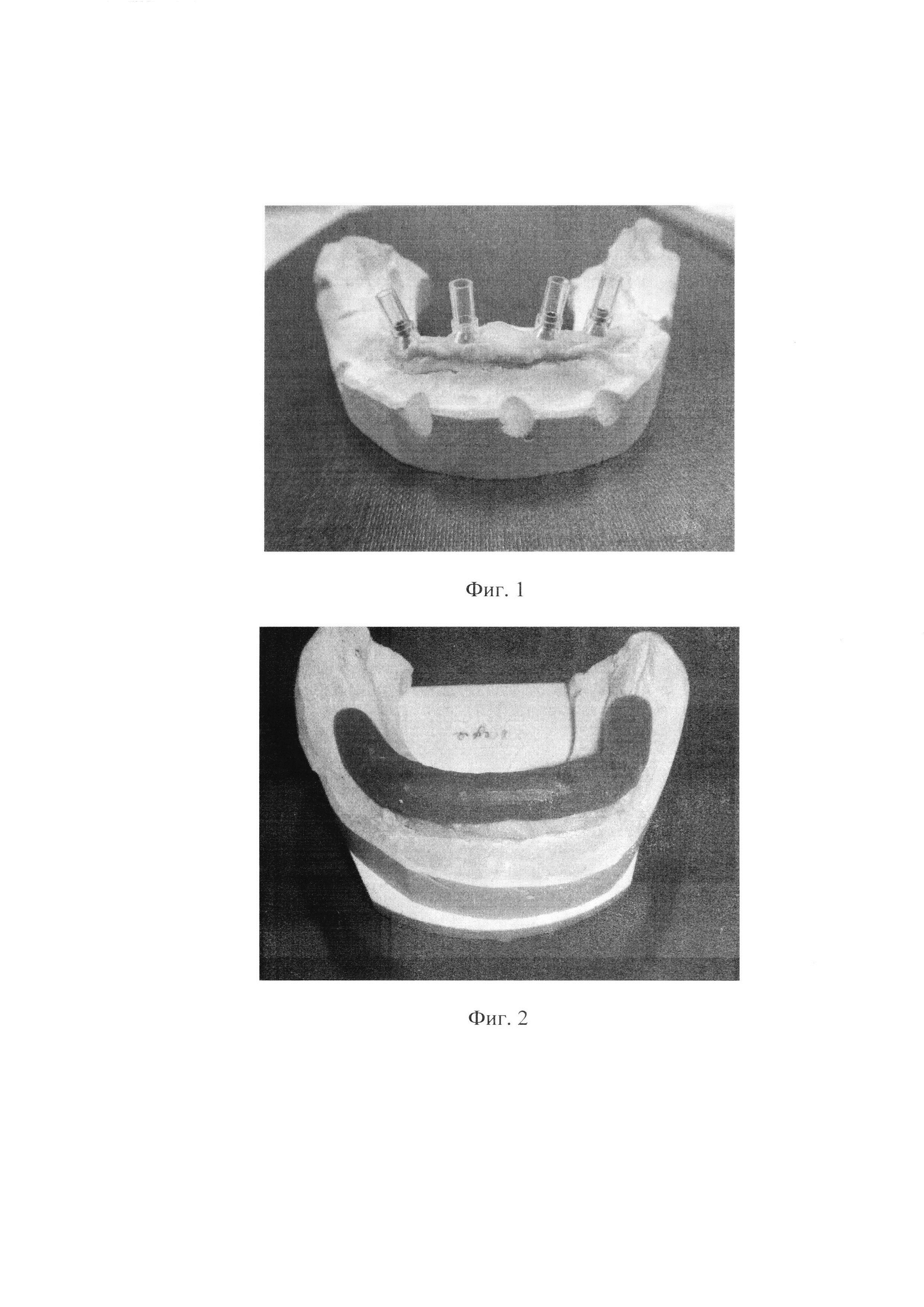 Способ определения центрального соотношения челюстей при изготовлении ортопедических конструкций, опирающихся на дентальные имплантаты, при полном отсутствии зубов