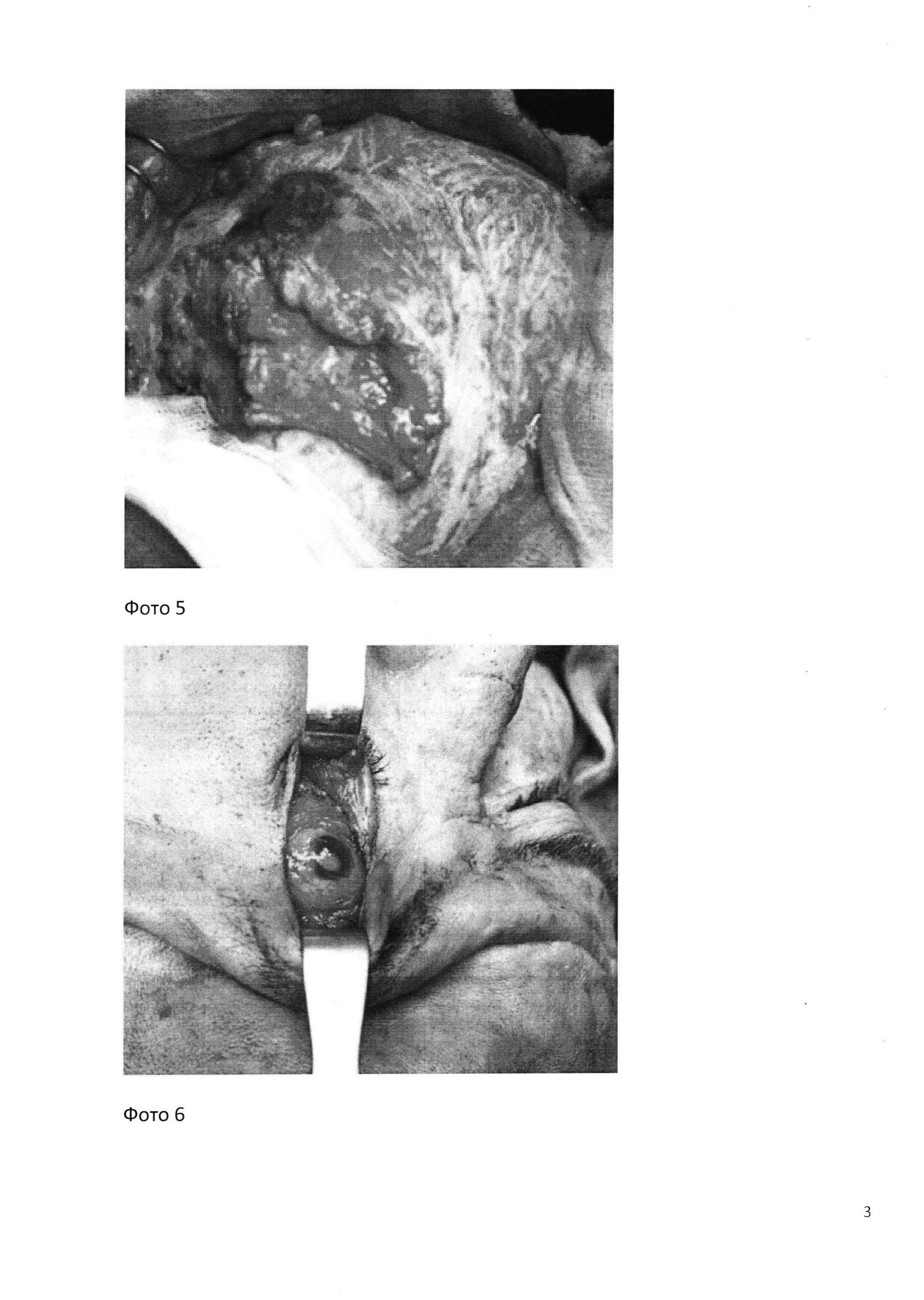 Способ доступа к верхней челюсти и скулоорбитальному комплексу при хирургическом лечении опухолей