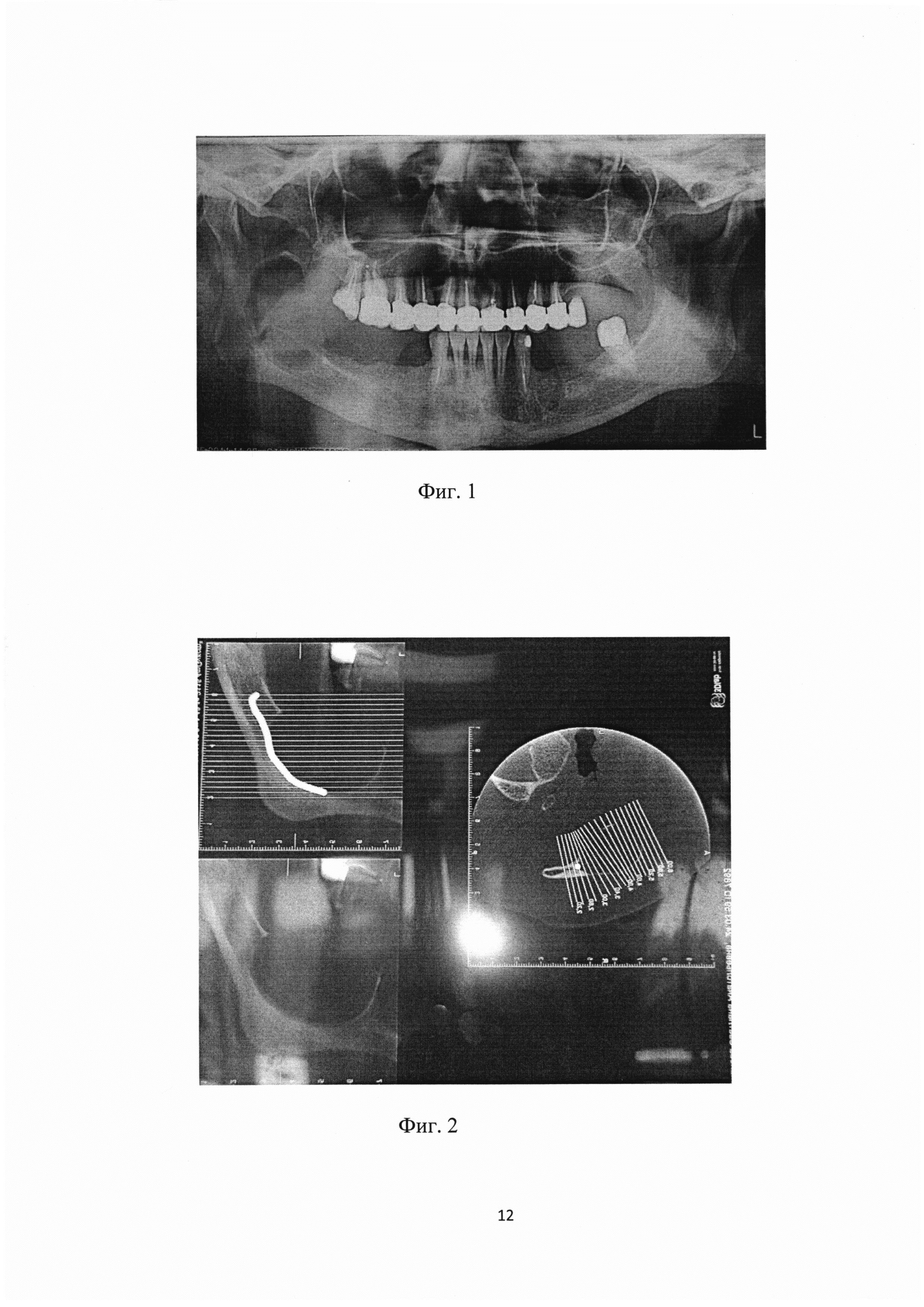 Способ хирургического лечения кистозных образований нижней челюсти больших размеров