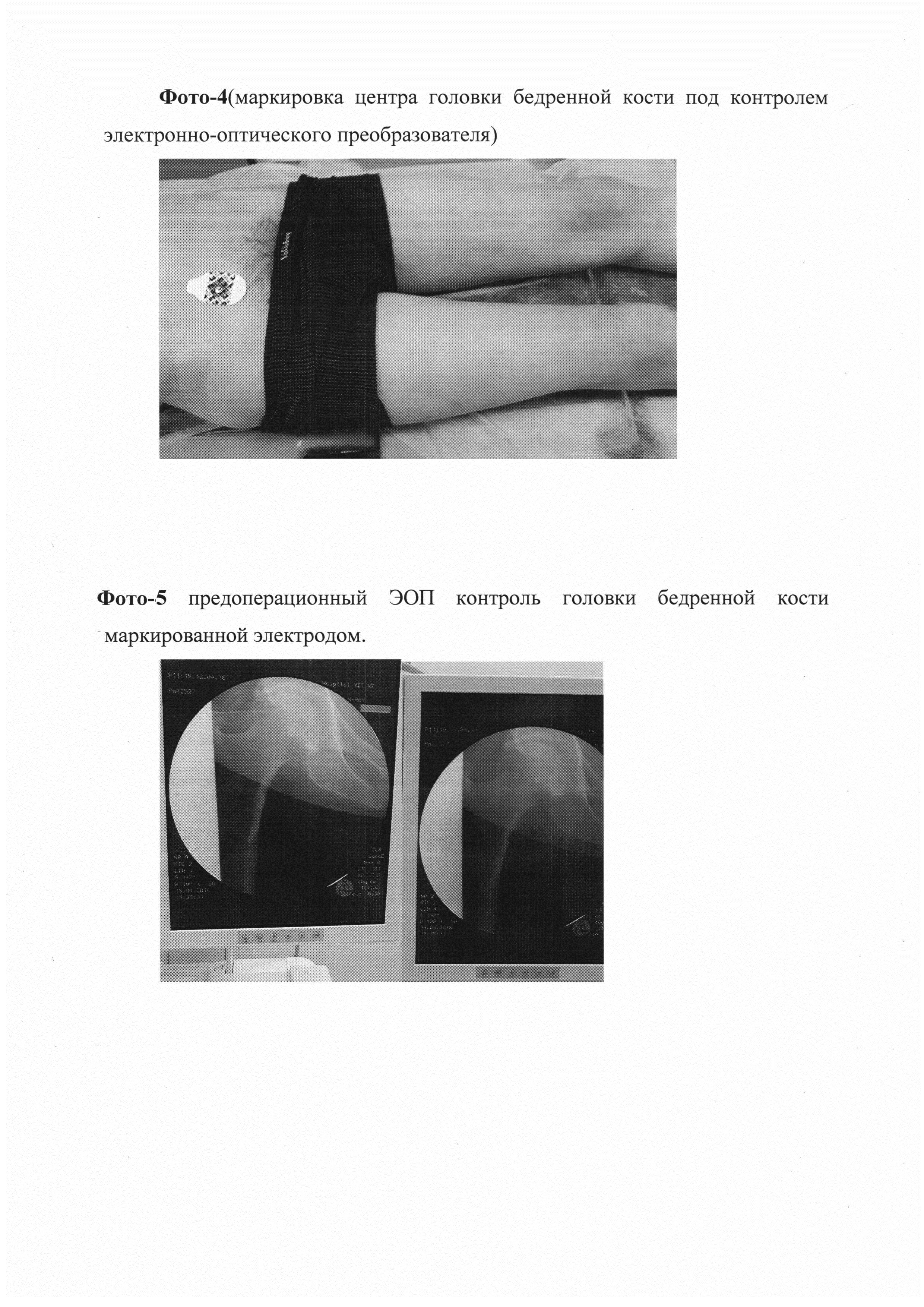 Способ фронтального выравнивания механической оси бедренной кости при тотальном эндопротезировании коленного сустава