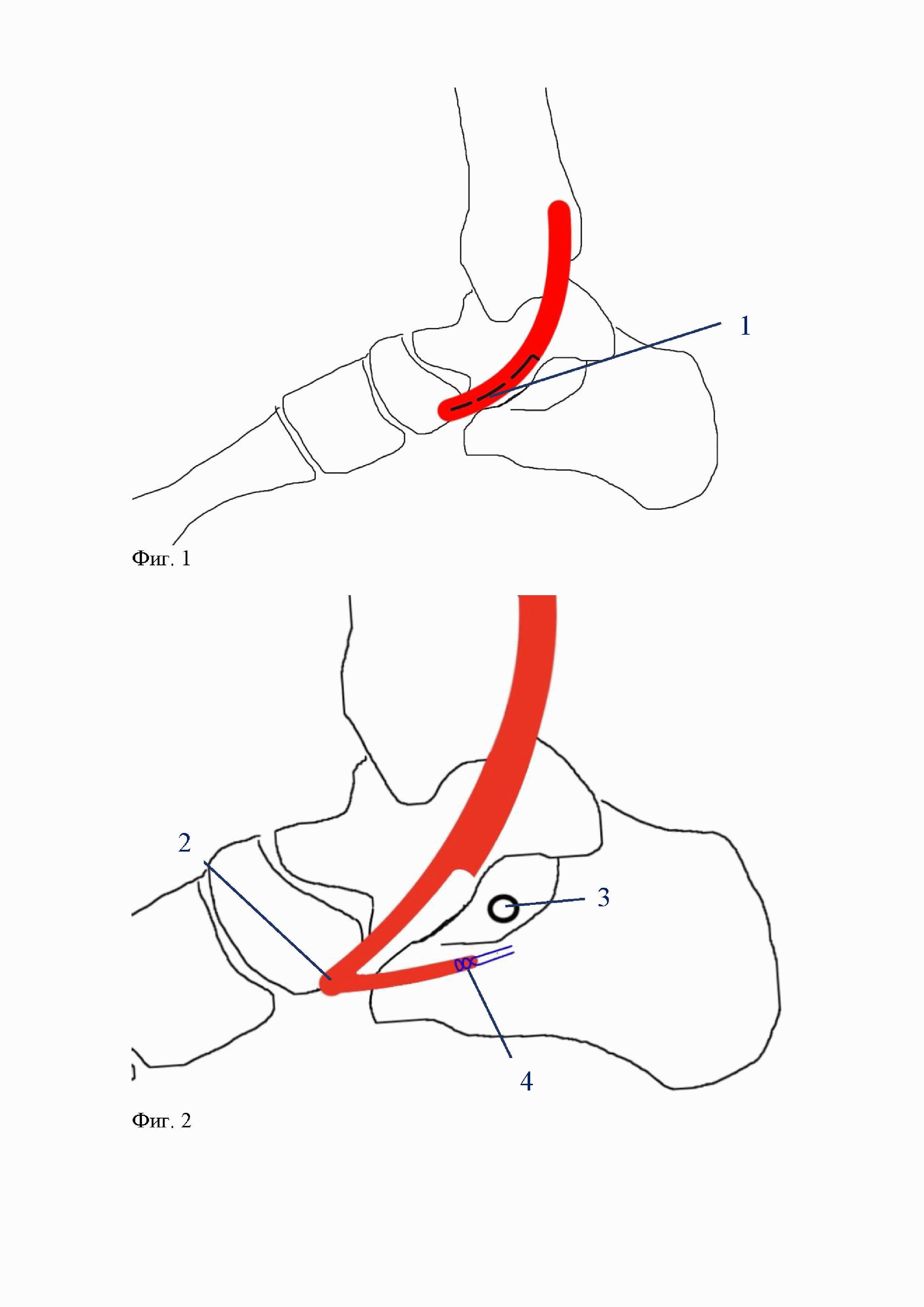 Способ реконструкции подошвенной пяточно-ладьевидной связки при лечении пациентов с плоско-вальгусной деформацией стопы