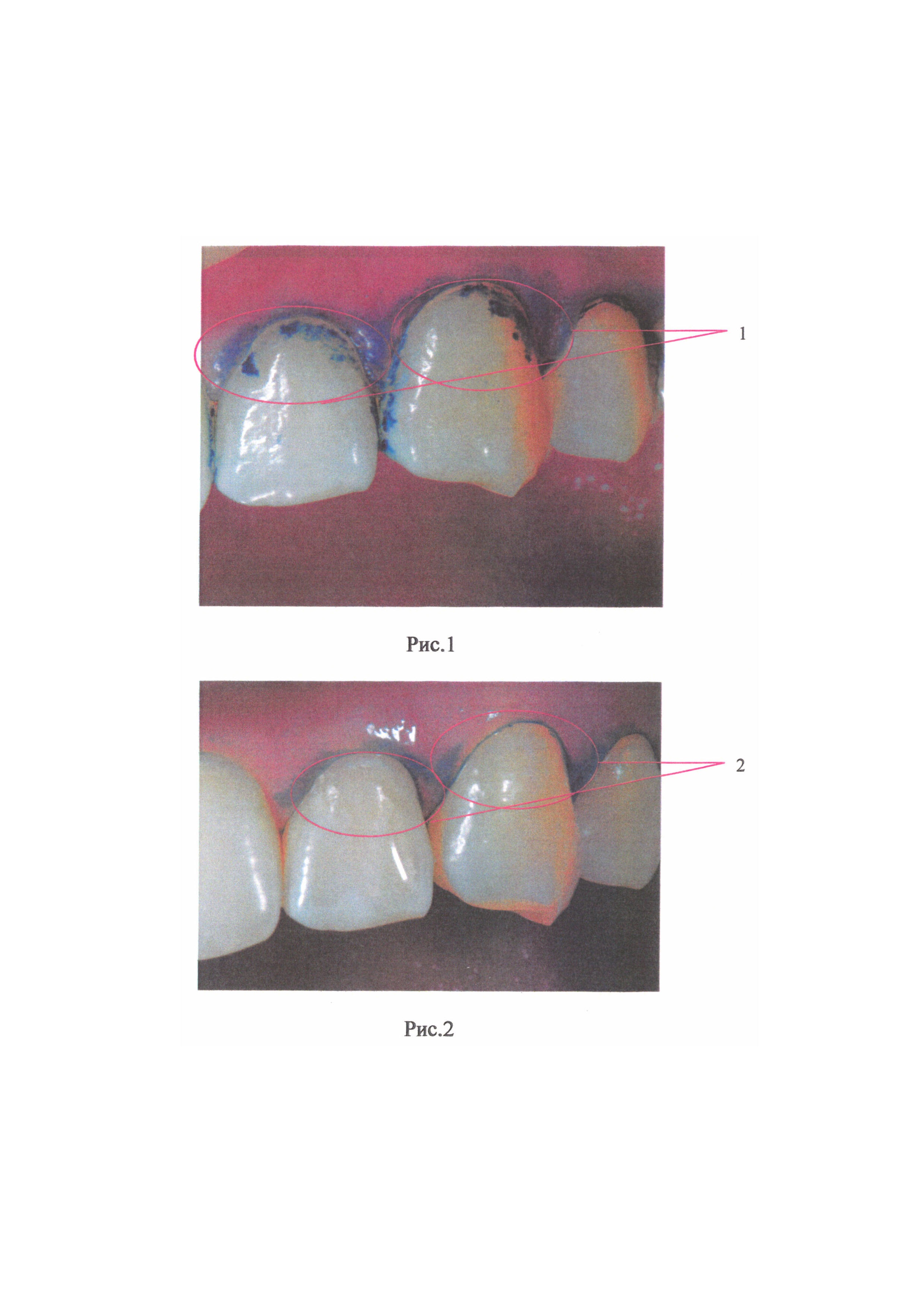 Гидрогель для реминерализации твердых тканей зубов