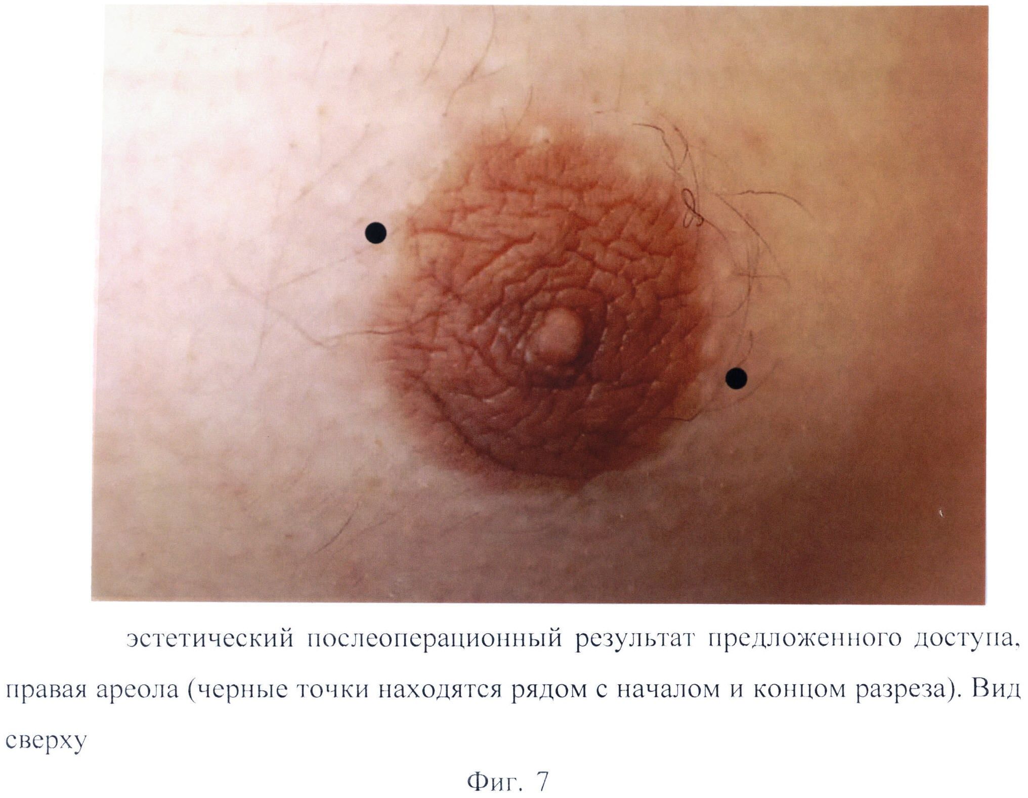 изменения ареолы груди при беременности фото 27