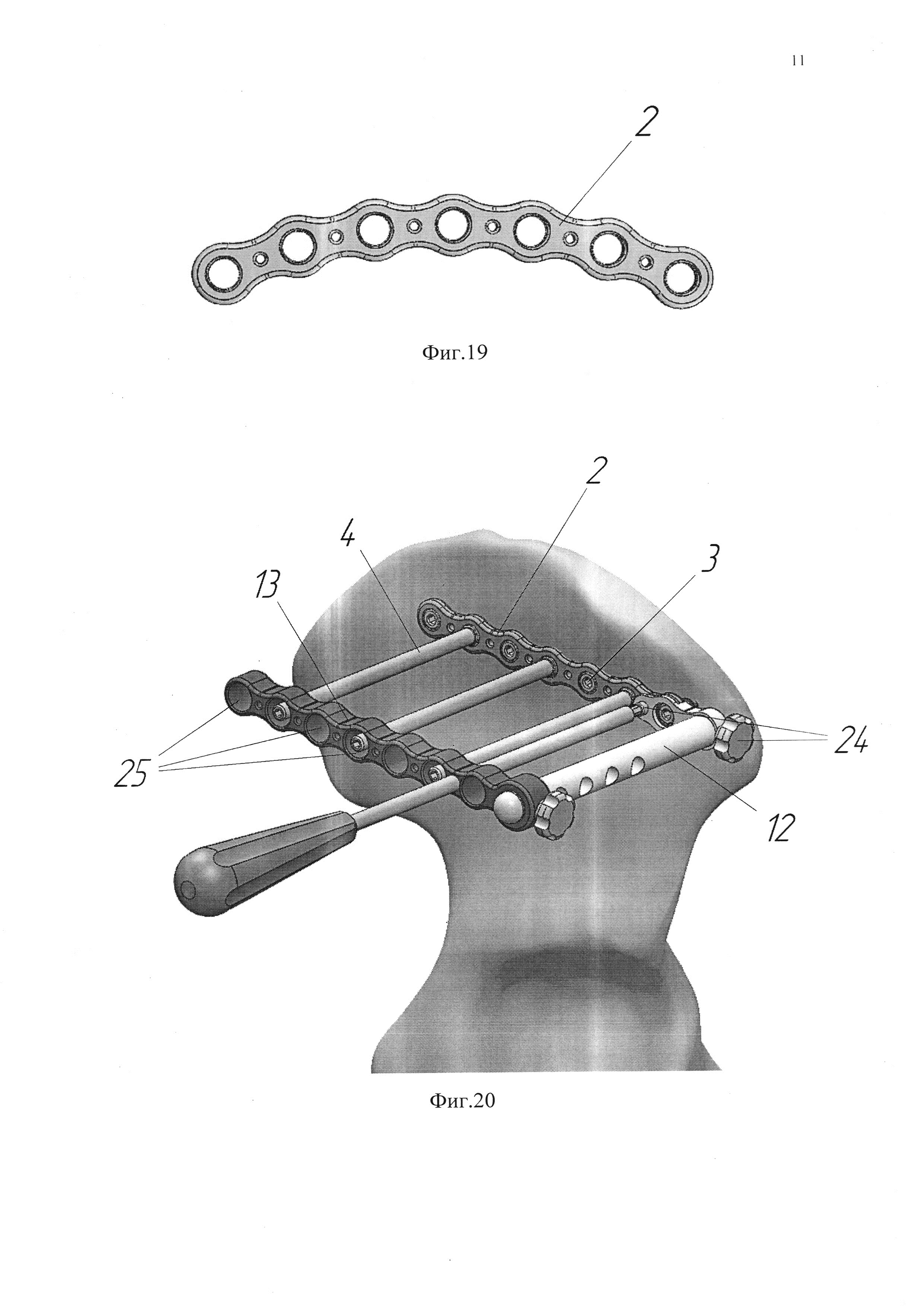 RU2288657C2 - Способ лечения гипопластического коксартроза - Google Patents