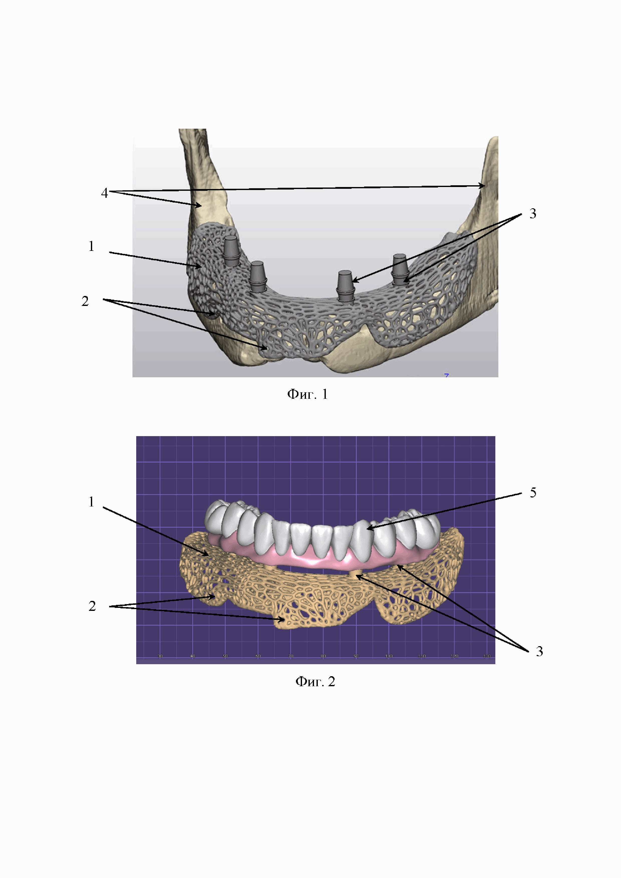 Способ замещения костных дефектов челюстей с возможностью временного зубного протезирования на период интеграции дентальных имплантатов