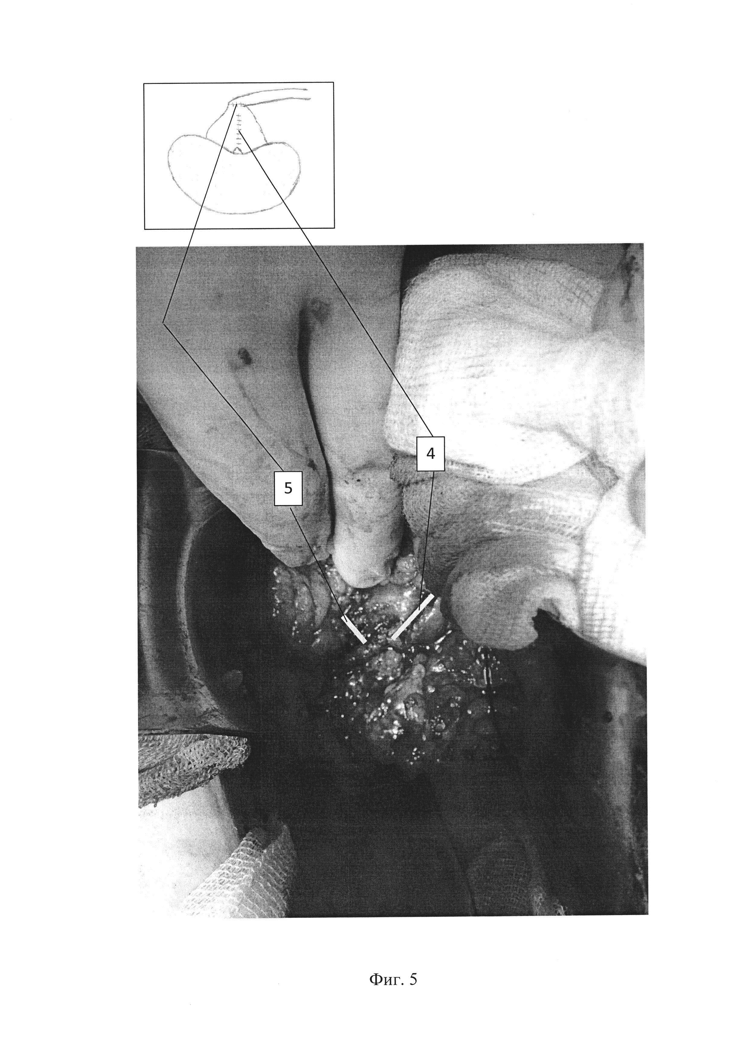 Способ хирургического лечения врожденного гидронефроза при удвоении почечной лоханки
