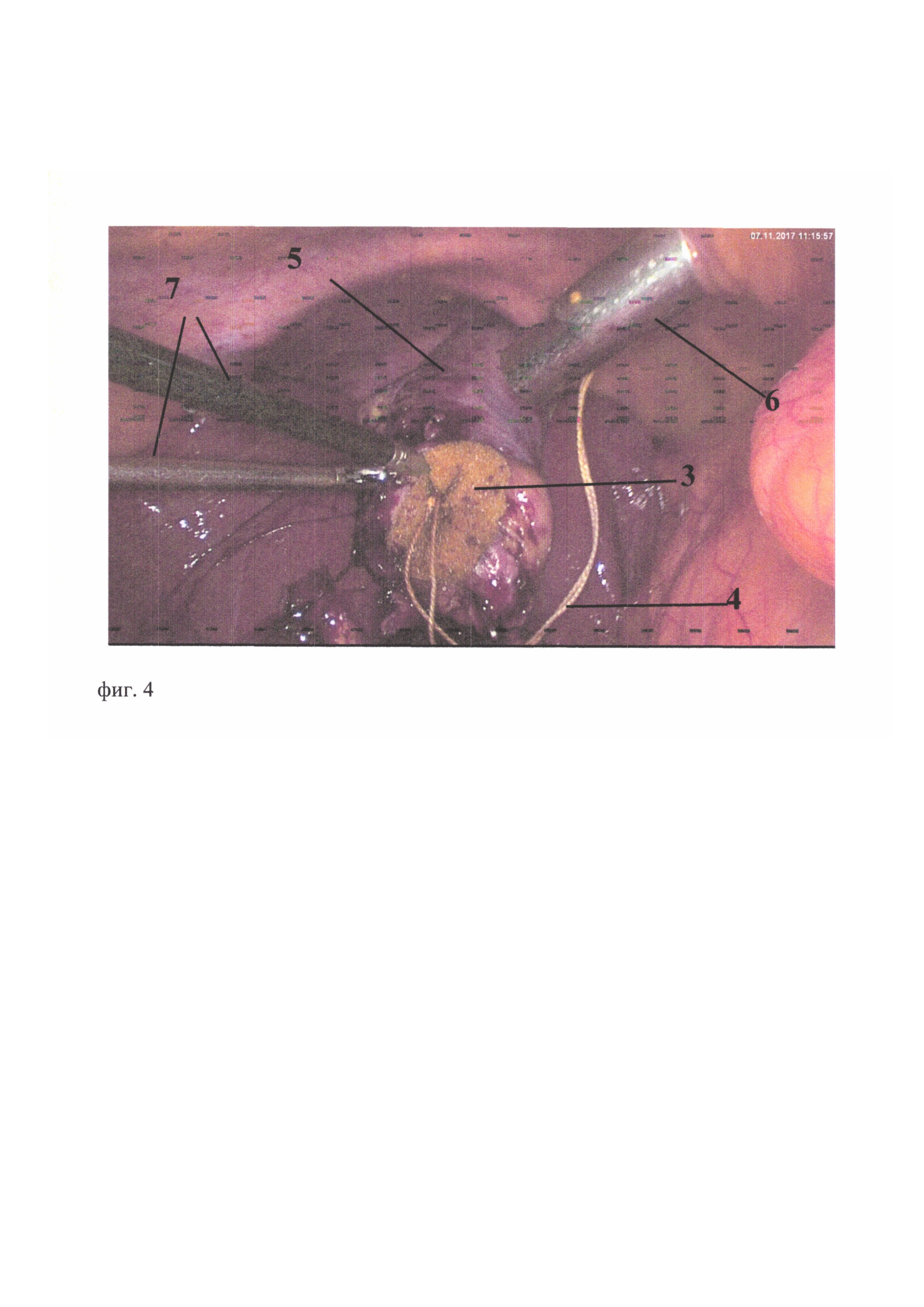 Устройство для окклюзии перфорации желчного пузыря во время лапароскопической холецистэктомии