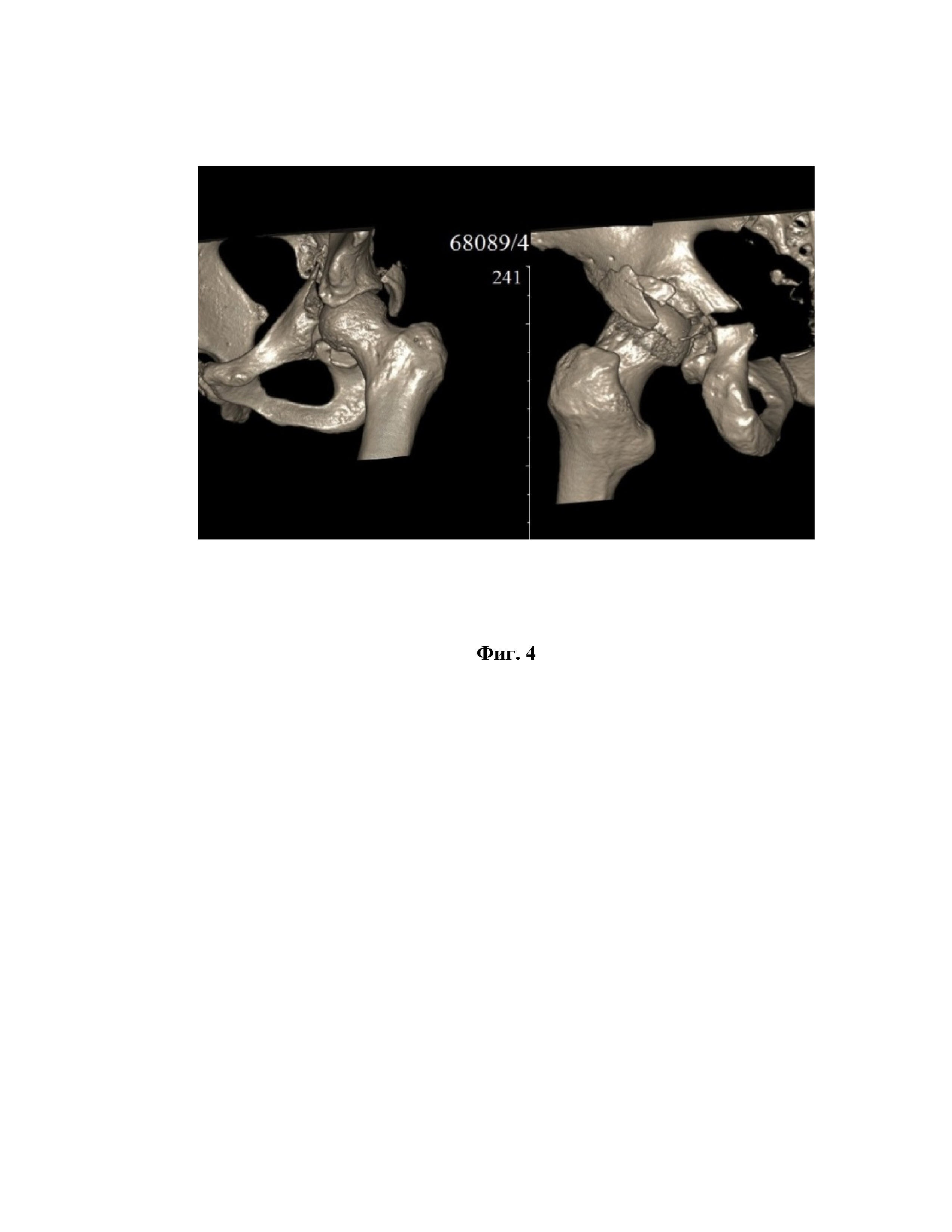 Способ определения показаний к ревизионному хирургическому вмешательству после первичного реконструктивного лечения переломов вертлужной впадины