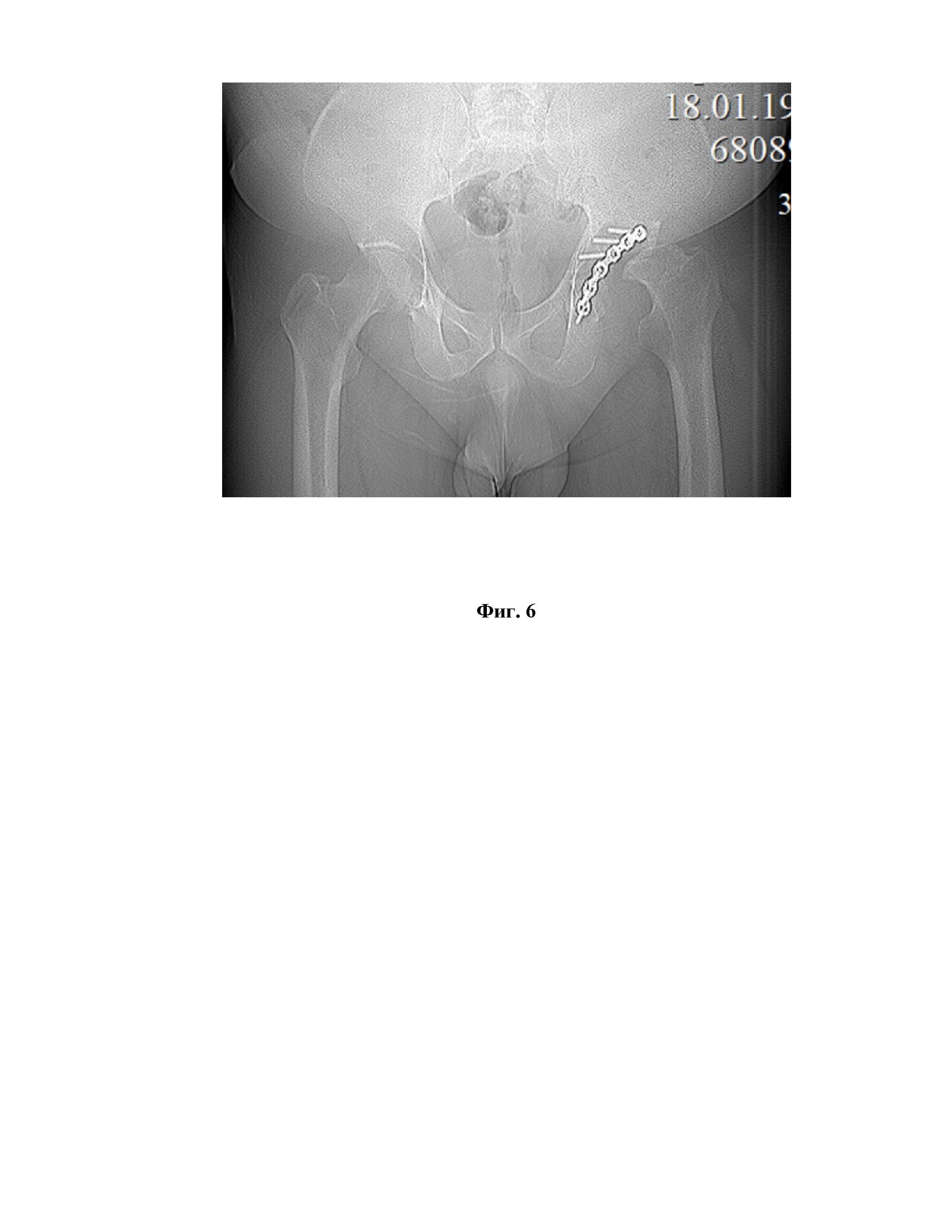 Способ определения показаний к ревизионному хирургическому вмешательству после первичного реконструктивного лечения переломов вертлужной впадины