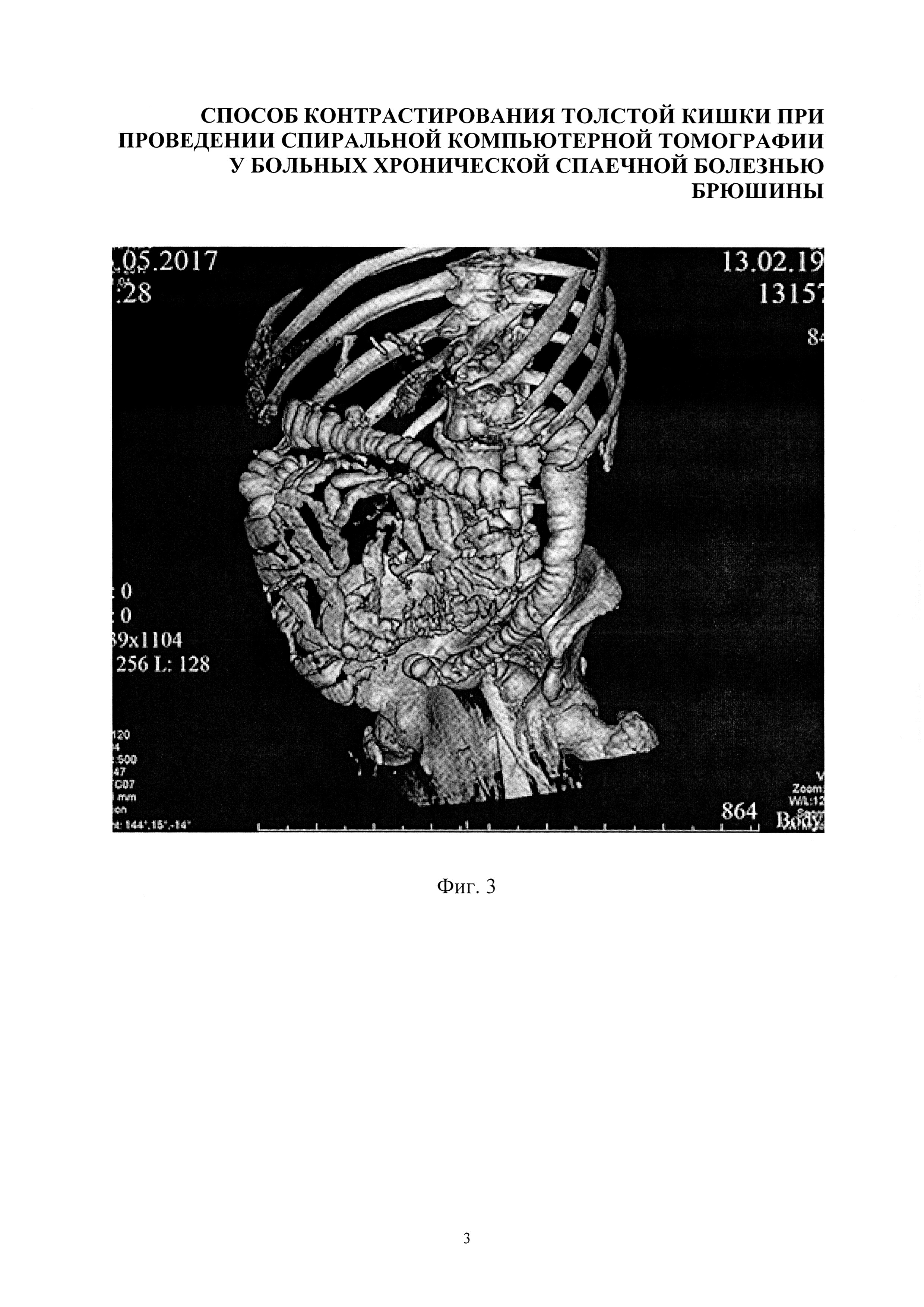 Спаечная болезнь компьютерная томография