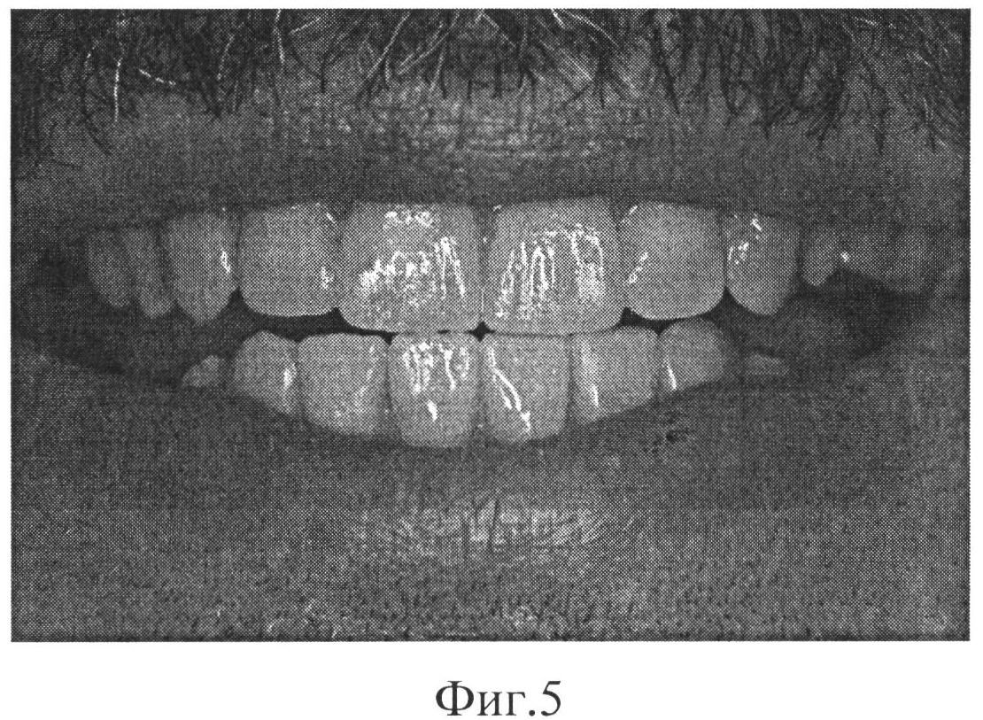 СПОСОБ ЭСТЕТИЧЕСКОЙ РЕСТАВРАЦИИ ЗУБОВ