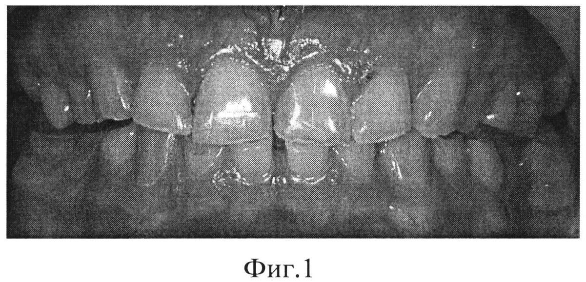 СПОСОБ ЭСТЕТИЧЕСКОЙ РЕСТАВРАЦИИ ЗУБОВ