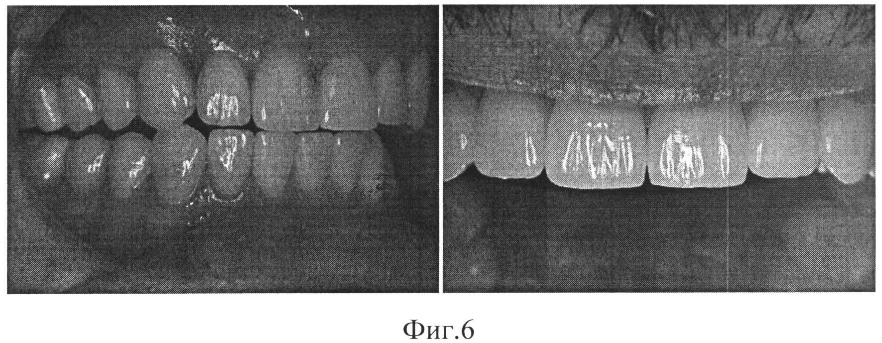 СПОСОБ ЭСТЕТИЧЕСКОЙ РЕСТАВРАЦИИ ЗУБОВ