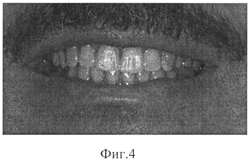 СПОСОБ ЭСТЕТИЧЕСКОЙ РЕСТАВРАЦИИ ЗУБОВ