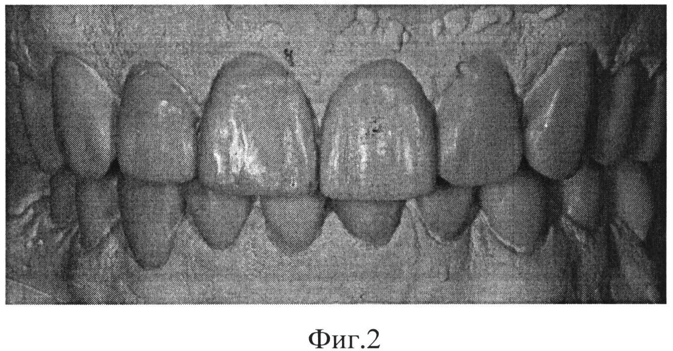 СПОСОБ ЭСТЕТИЧЕСКОЙ РЕСТАВРАЦИИ ЗУБОВ