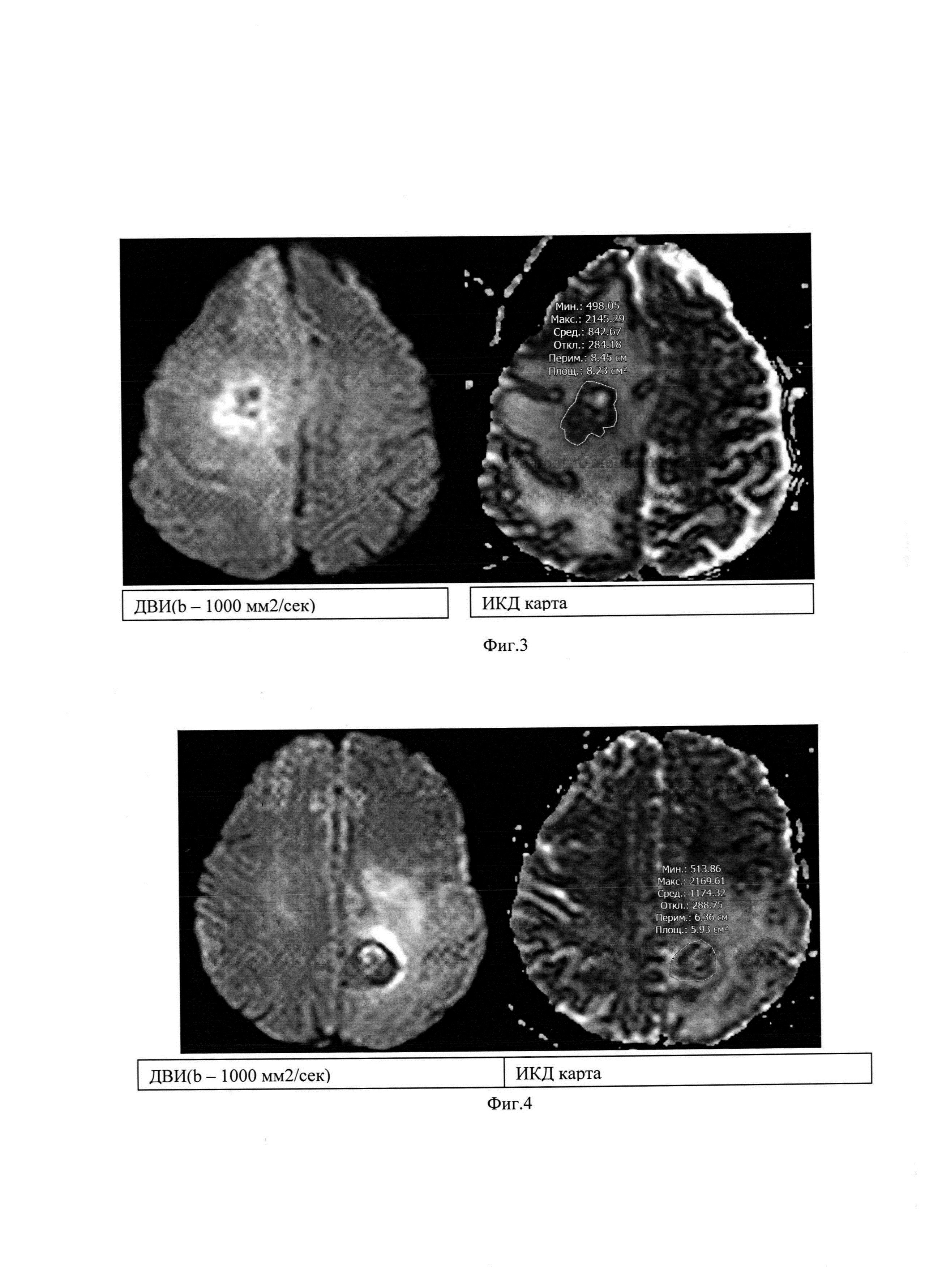 Способ прогнозирования течения заболевания у пациентов с метастазами в головной мозг