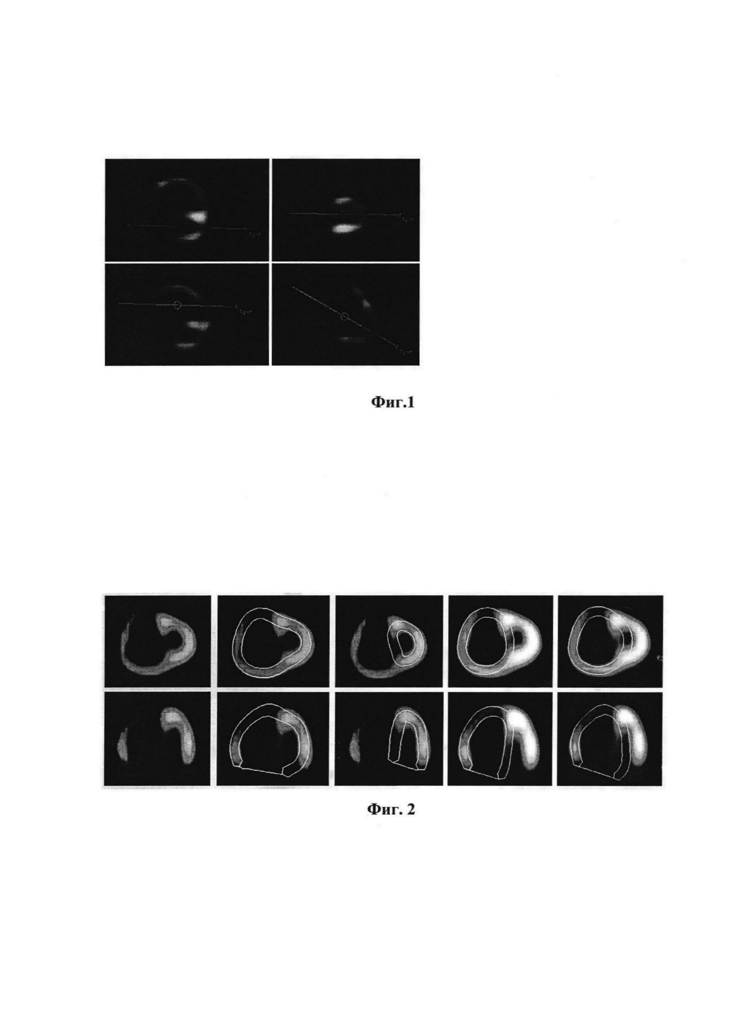 Способ количественной оценки нарушений перфузии миокарда правого желудочка по данным однофотонно-эмиссионной компьютерной томографии