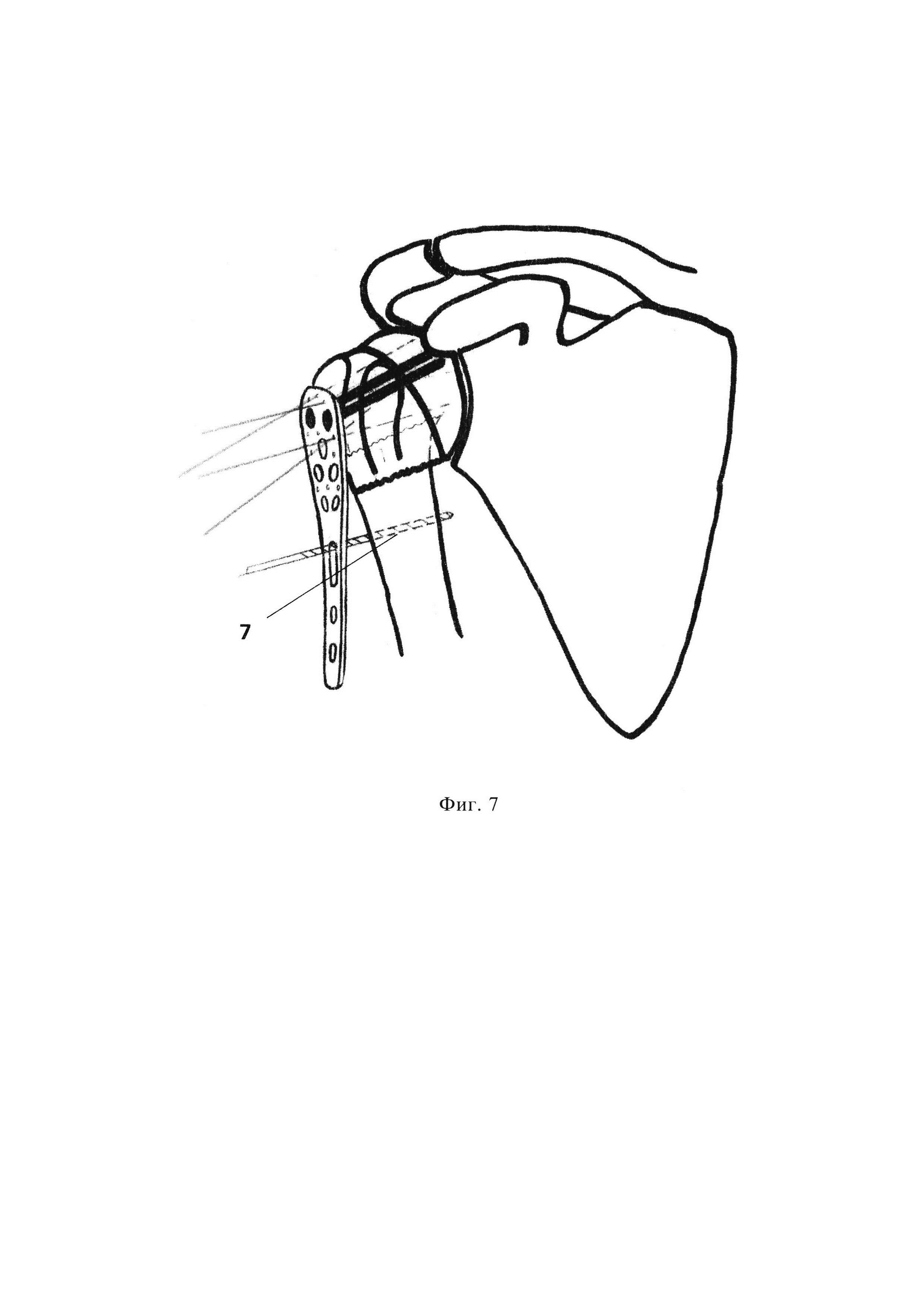 Способ оперативного лечения многооскольчатого перелома хирургической шейки плечевой кости