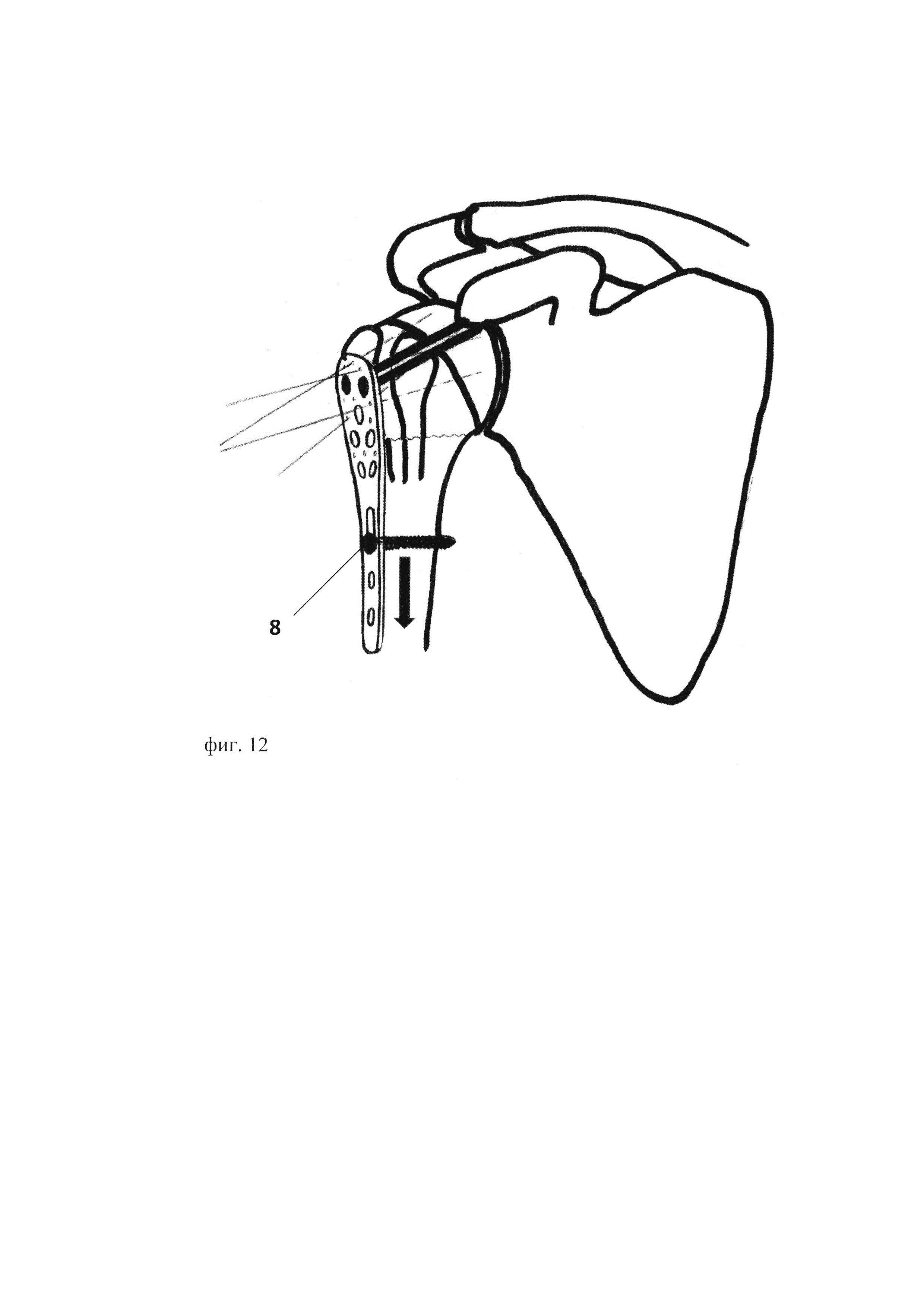 Способ оперативного лечения многооскольчатого перелома хирургической шейки плечевой кости