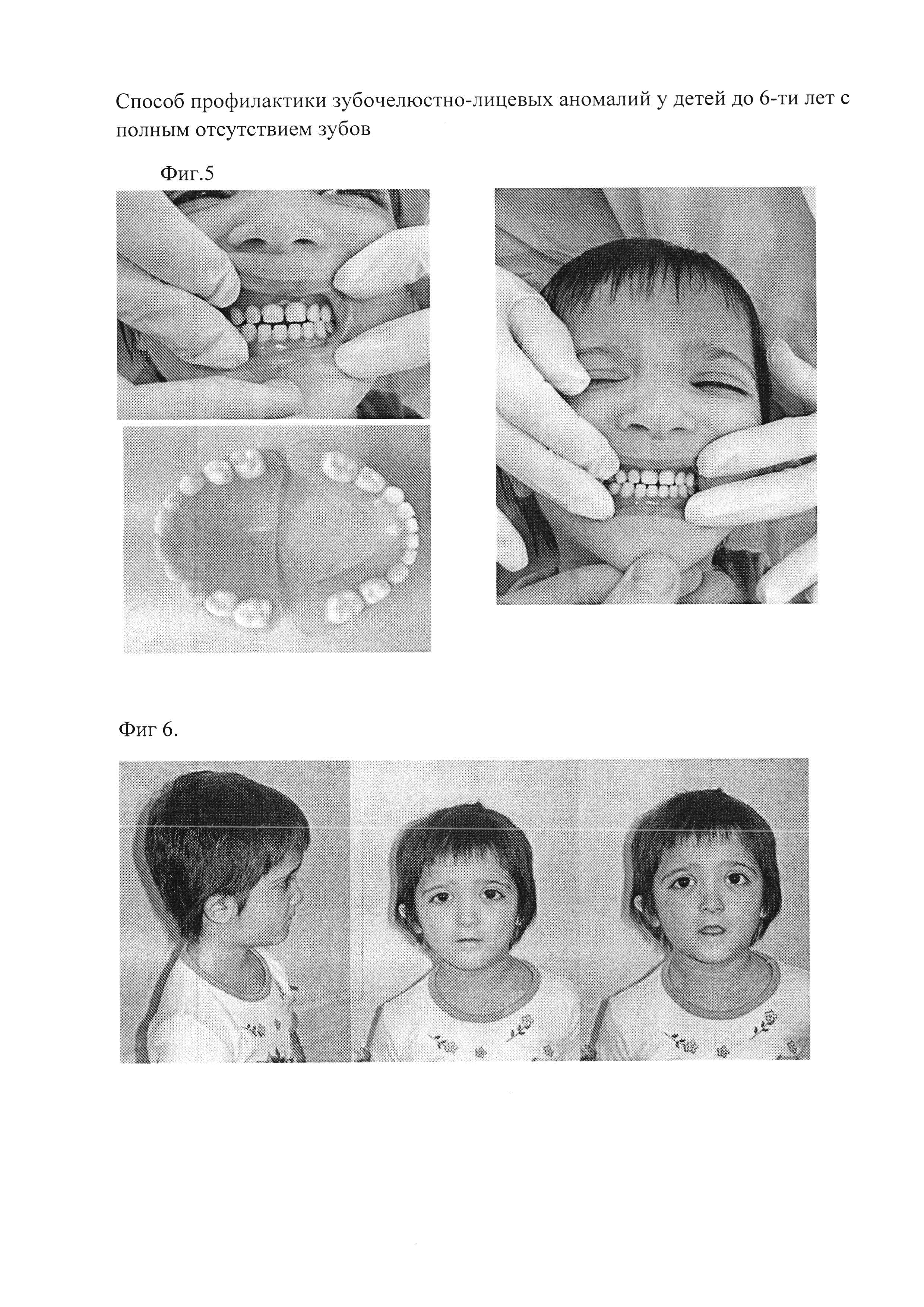 Способ профилактики зубочелюстно-лицевых аномалий у детей до 6 лет с полным отсутствием зубов