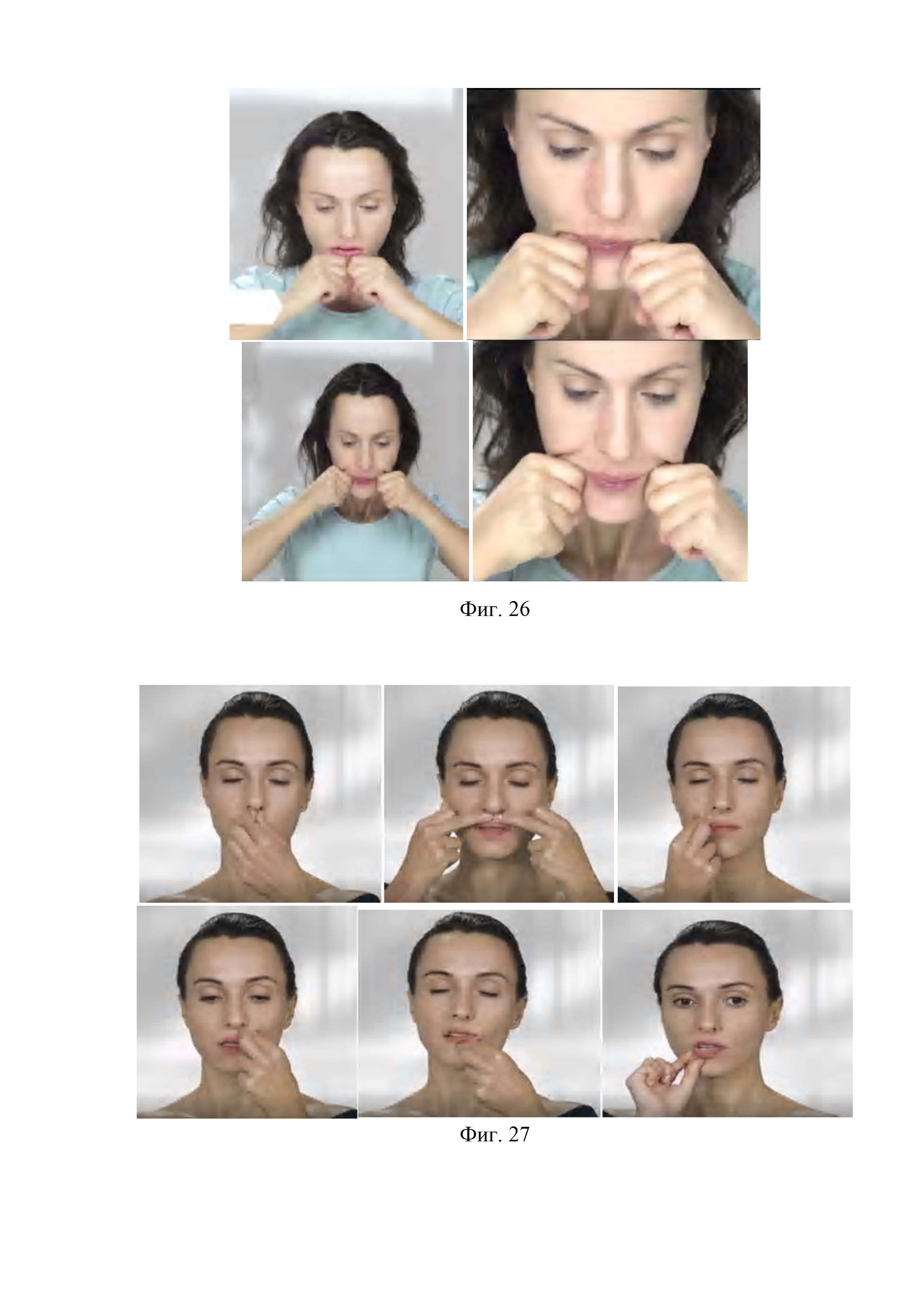 Способ нейро-мышечной релаксации лицевых мышц