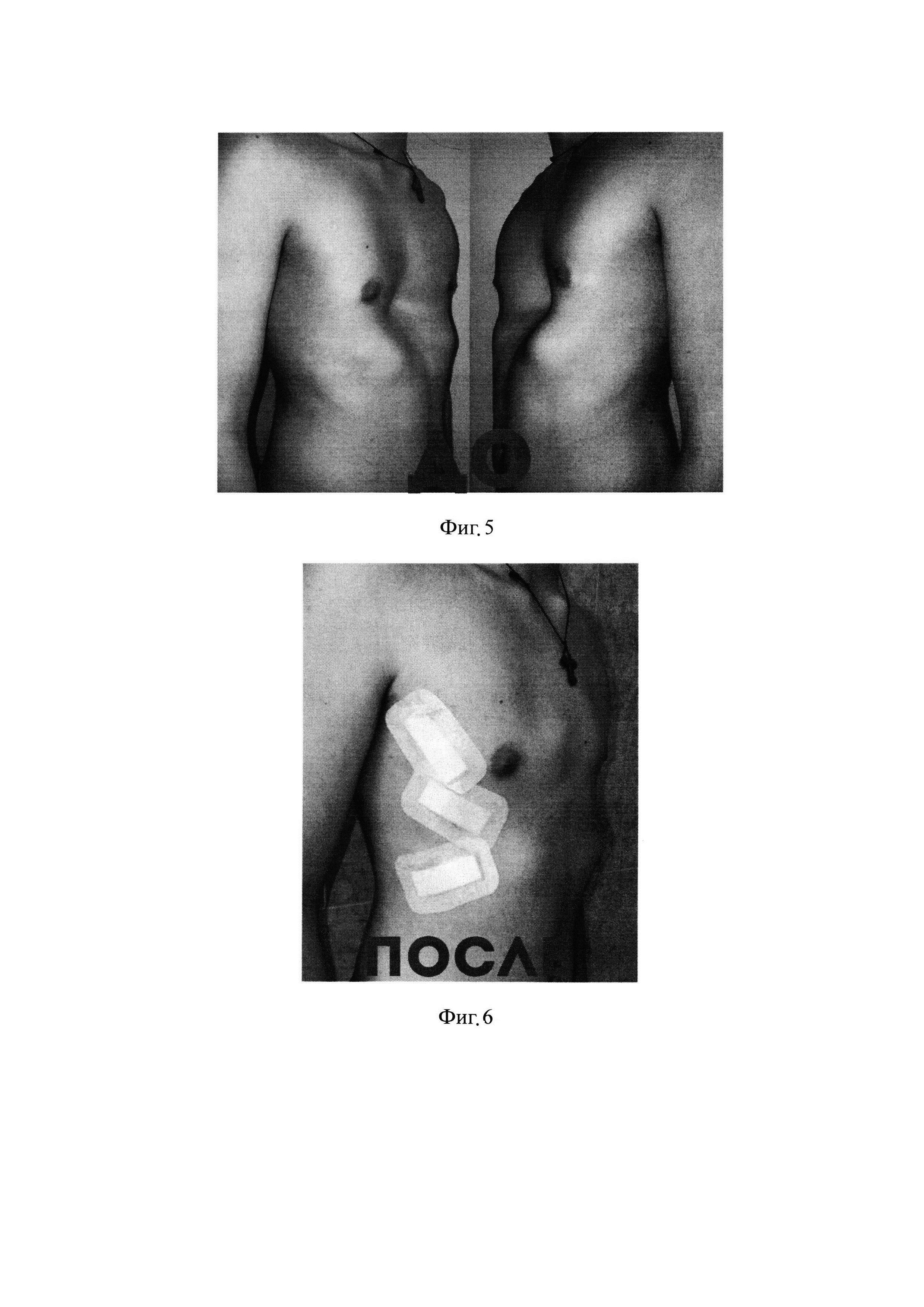 Способ хирургического лечения воронкообразной деформации грудной клетки