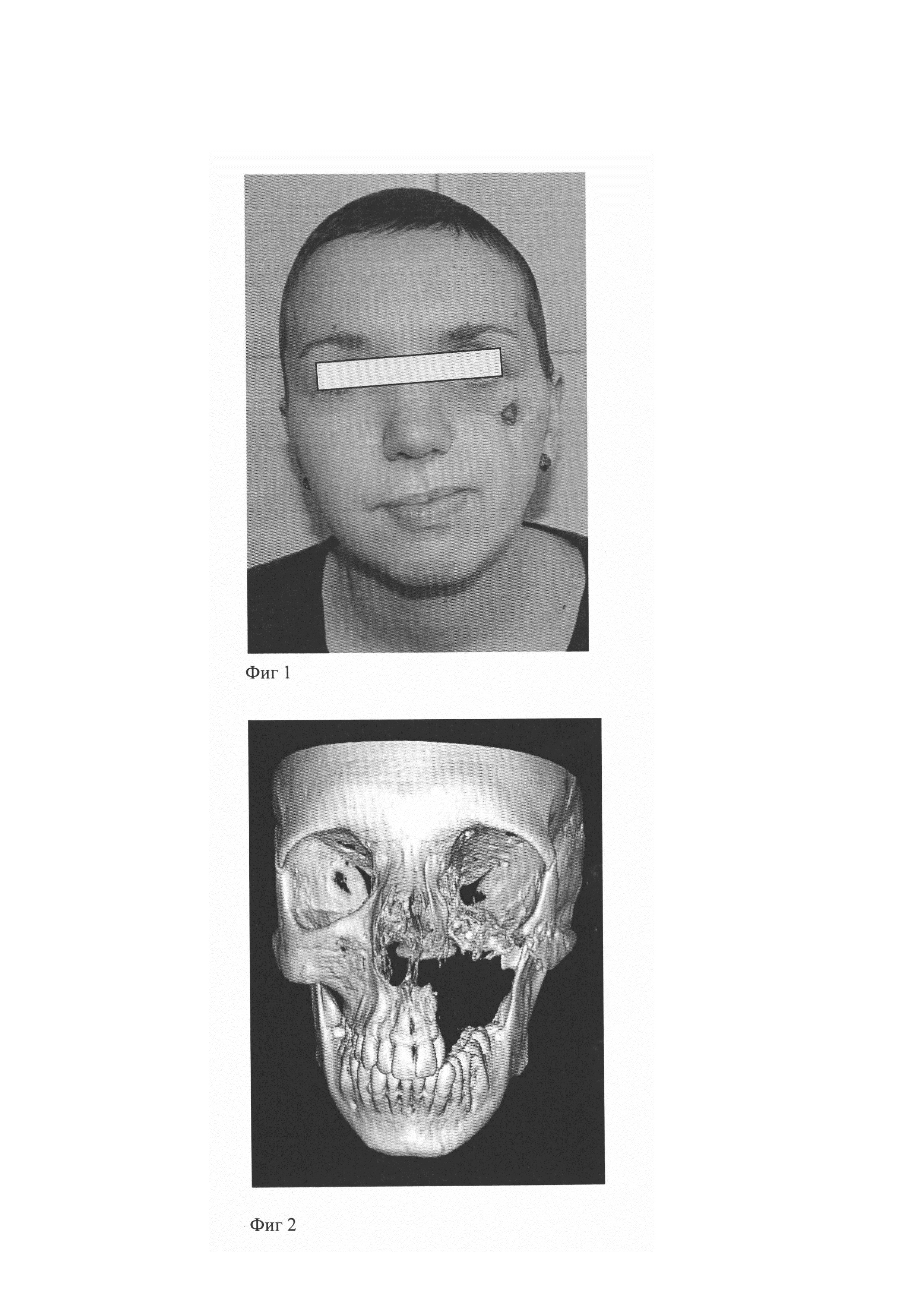 Способ реконструкции сложных дефектов челюстно-лицевой области