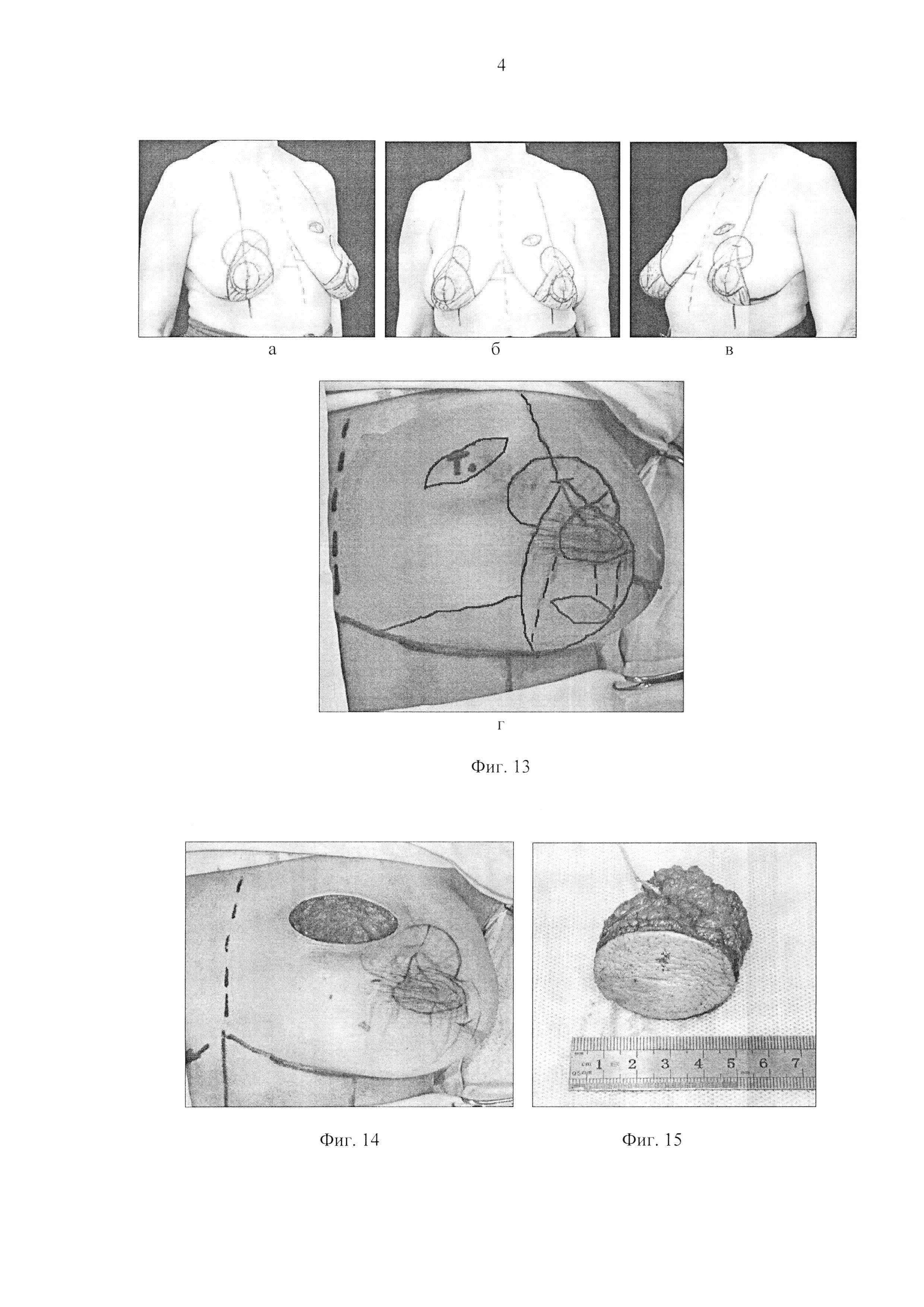операция опухоли груди у женщин фото 92