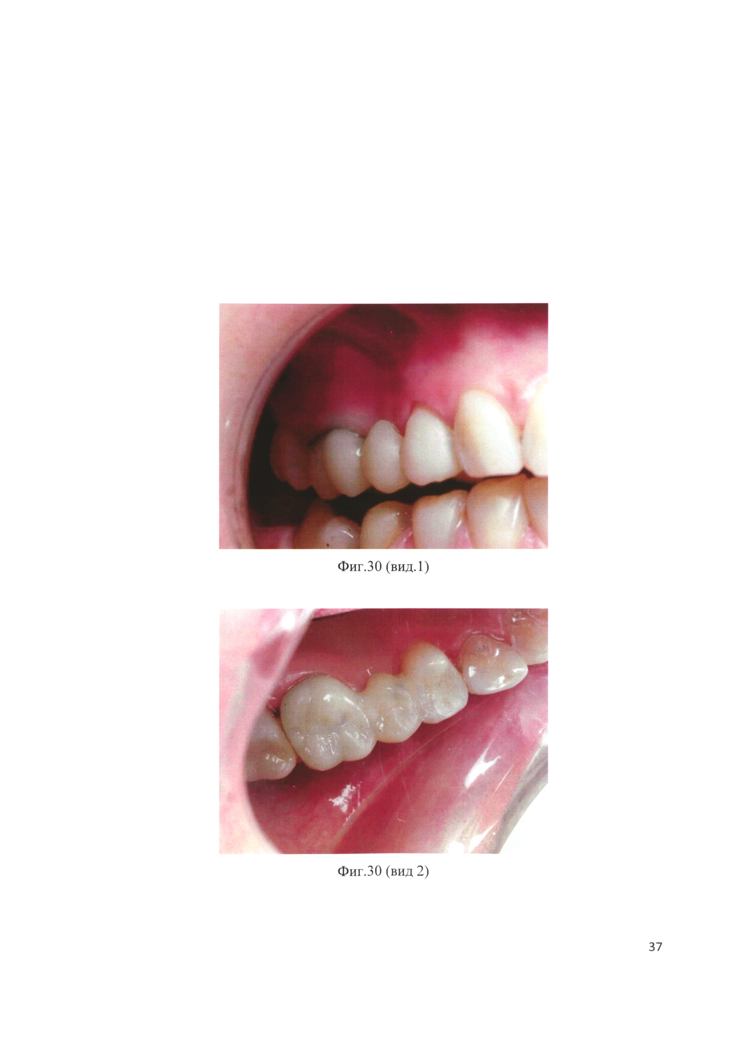 Способ восстановления коронковой части многокорневого зуба