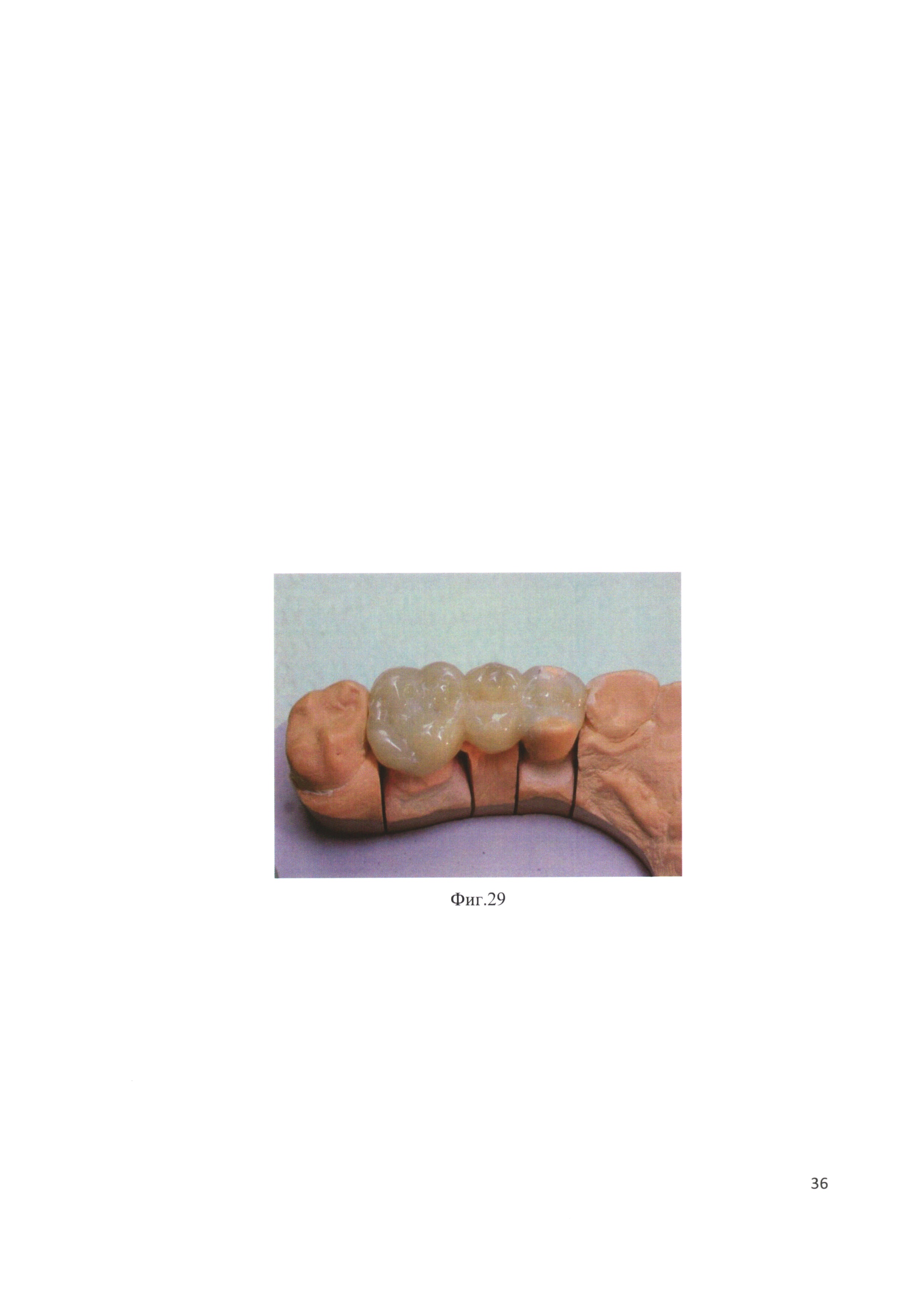 Способ восстановления коронковой части многокорневого зуба