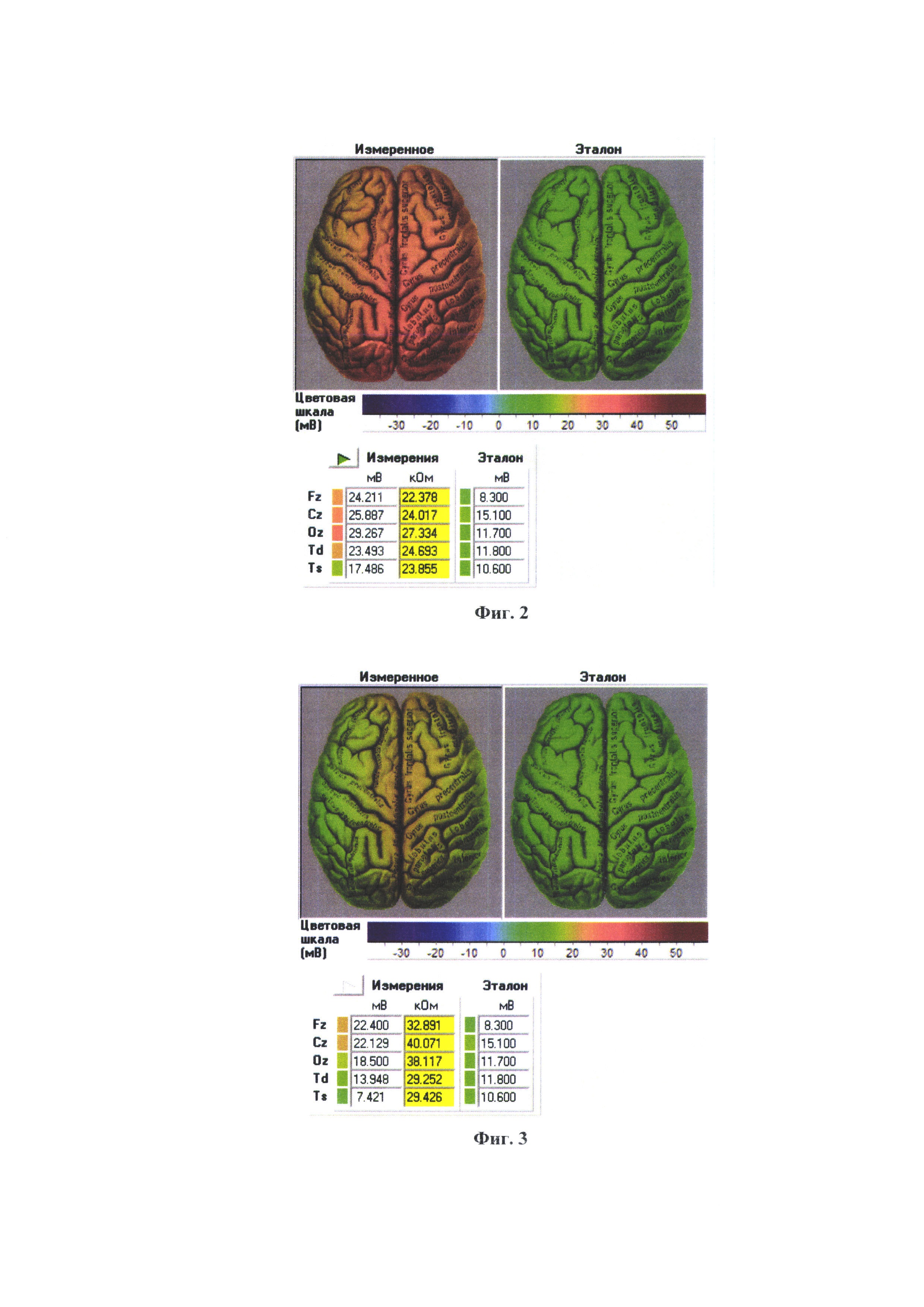 Способ цветокоррекции нарушений нейрометаболизма коры головного мозга