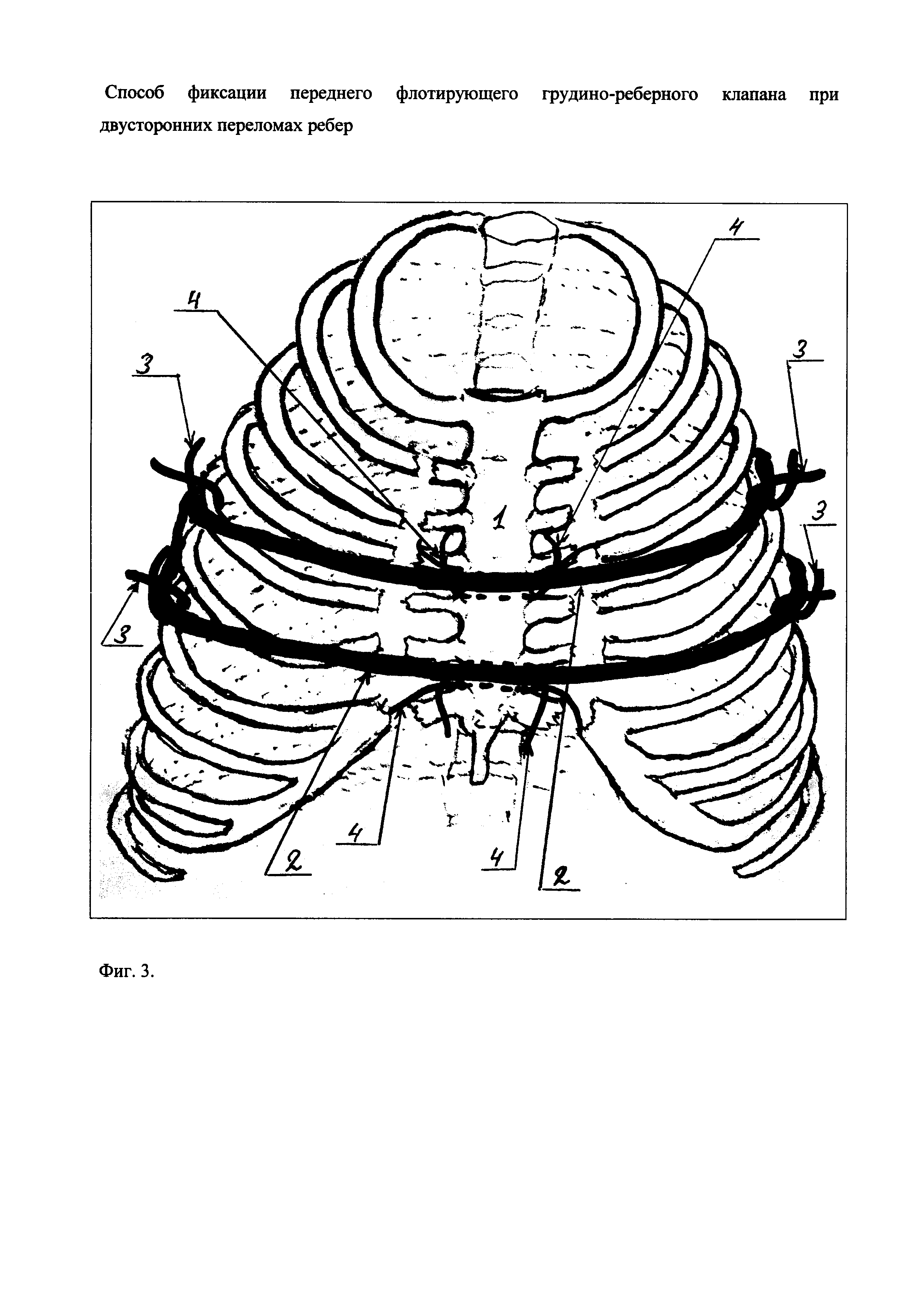 Способ фиксации переднего флотирующего грудино-реберного клапана при двусторонних переломах ребер