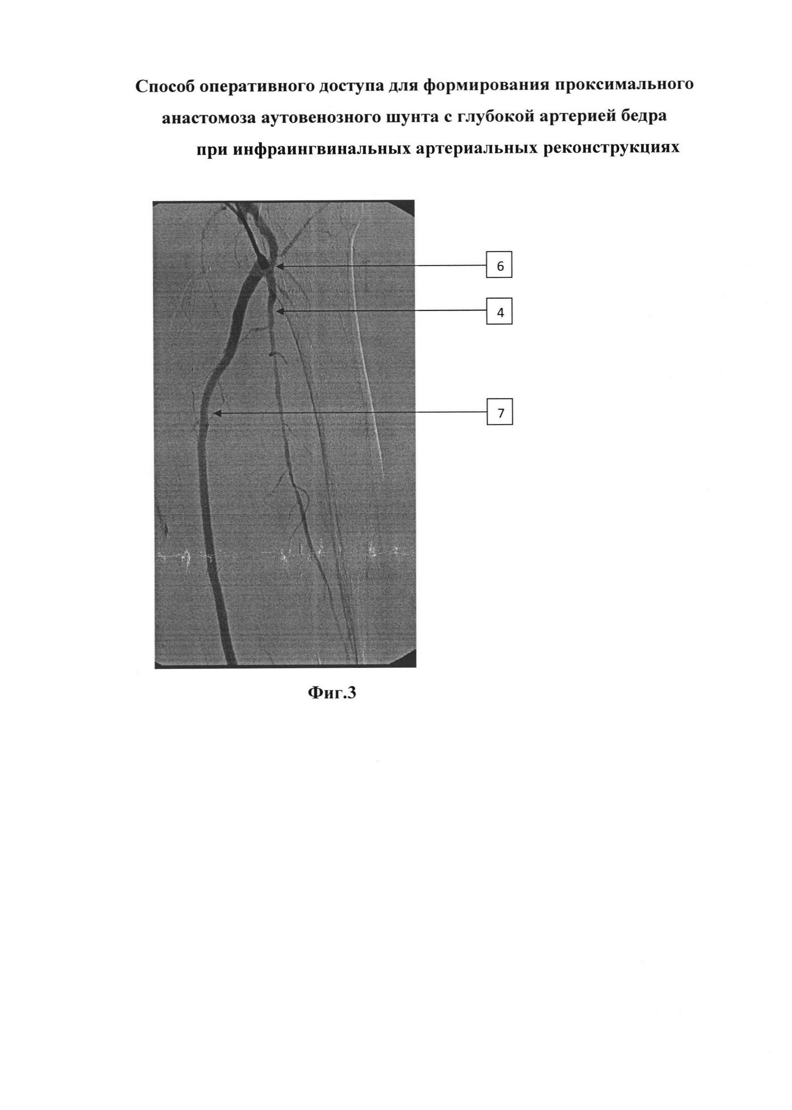 Способ оперативного доступа для формирования проксимального анастомоза аутовенозного шунта с глубокой артерией бедра при инфраингвинальных артериальных реконструкциях