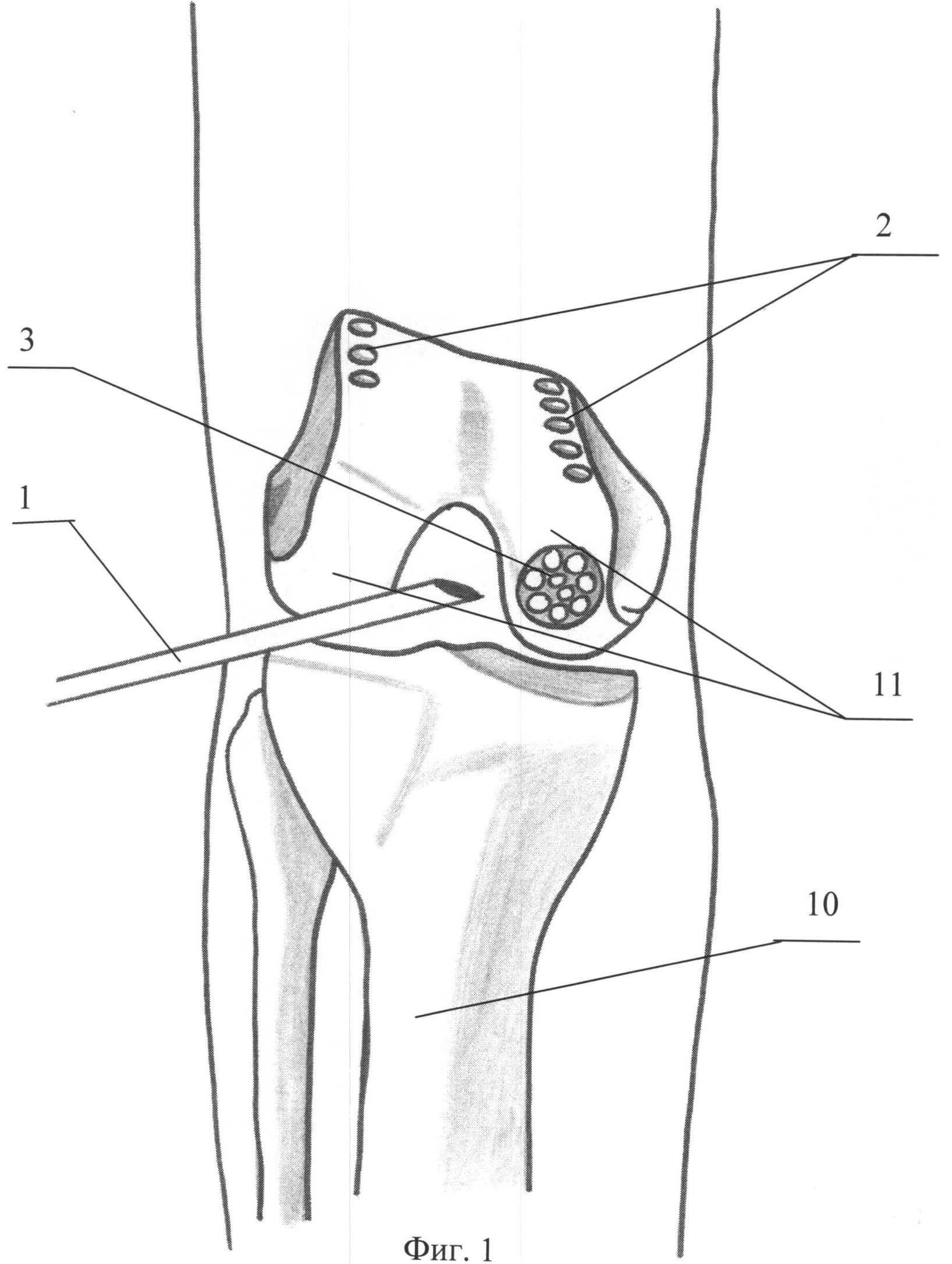 Внутренние мыщелки. Мыщелка большеберцовой кости. Мыщелок коленного сустава. Костная аутопластика тазобедренного сустава. Аутопластика ПКС коленного.
