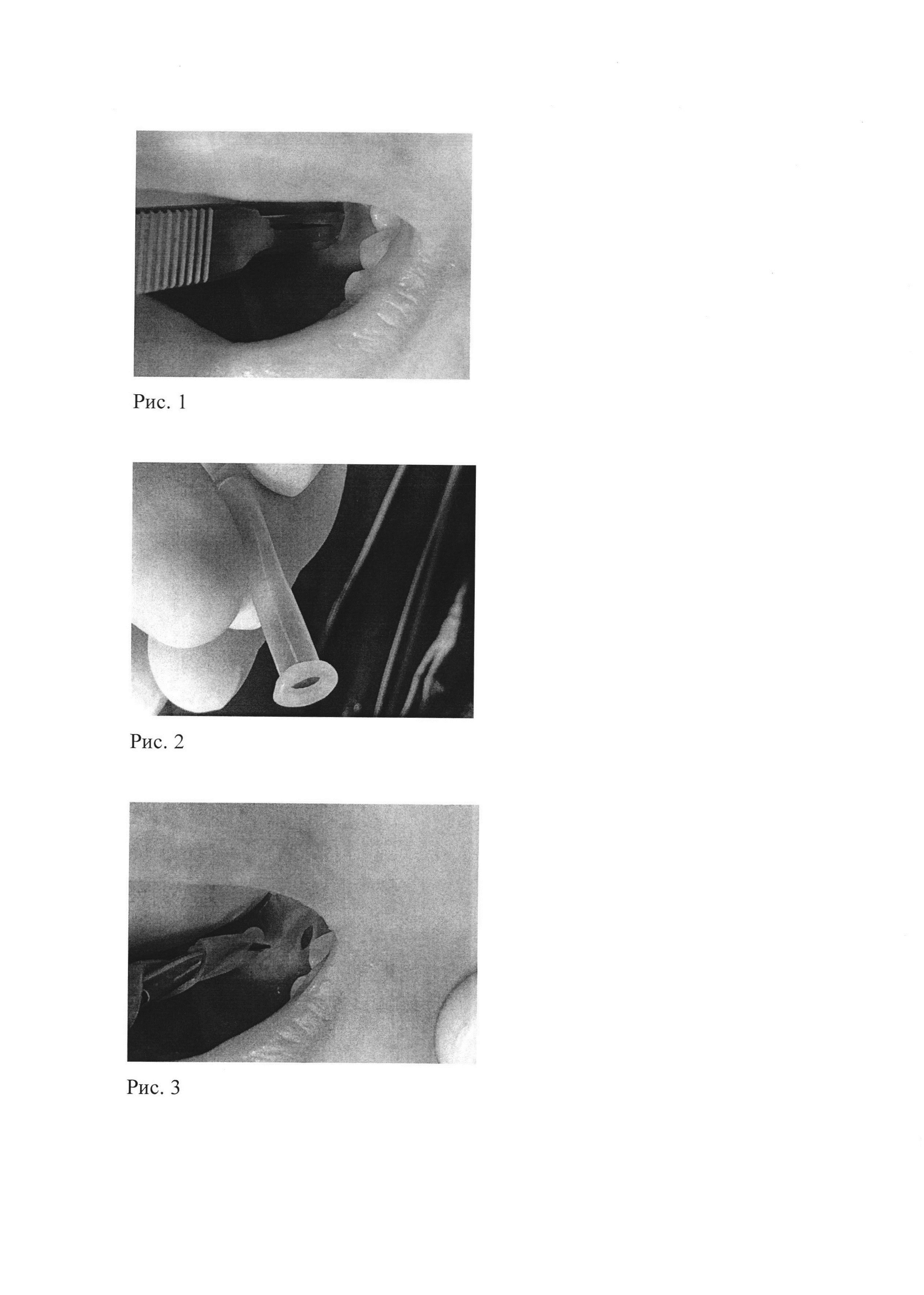 Способ лечения кисты подъязычной слюнной железы (ранулы)