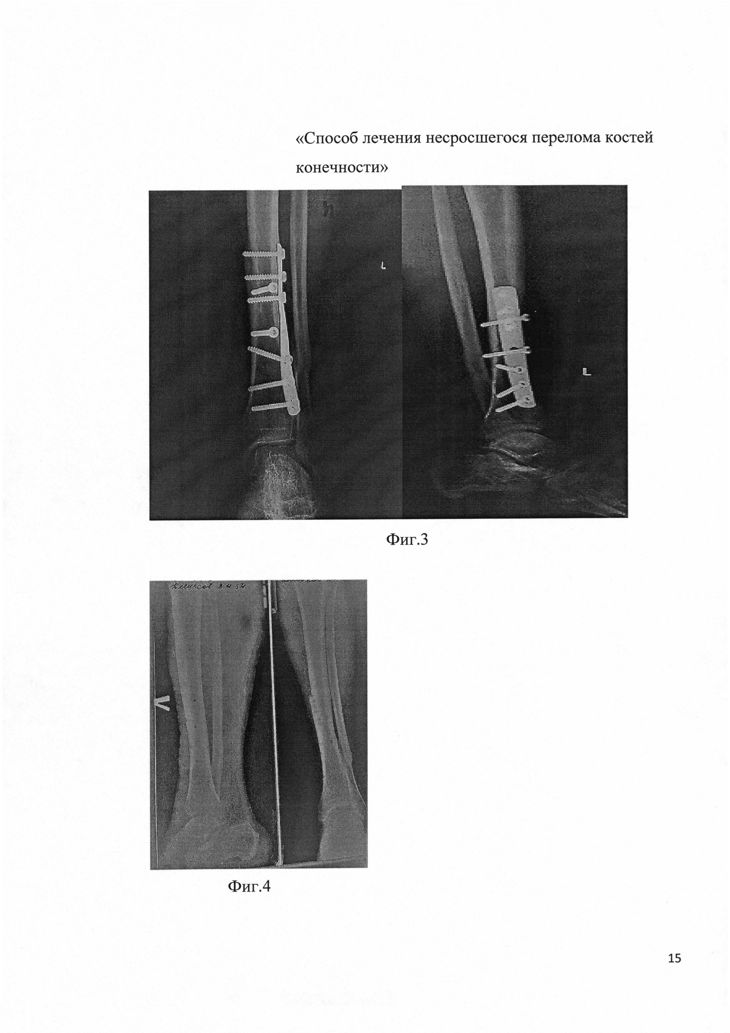Способ лечения несросшегося перелома костей конечности