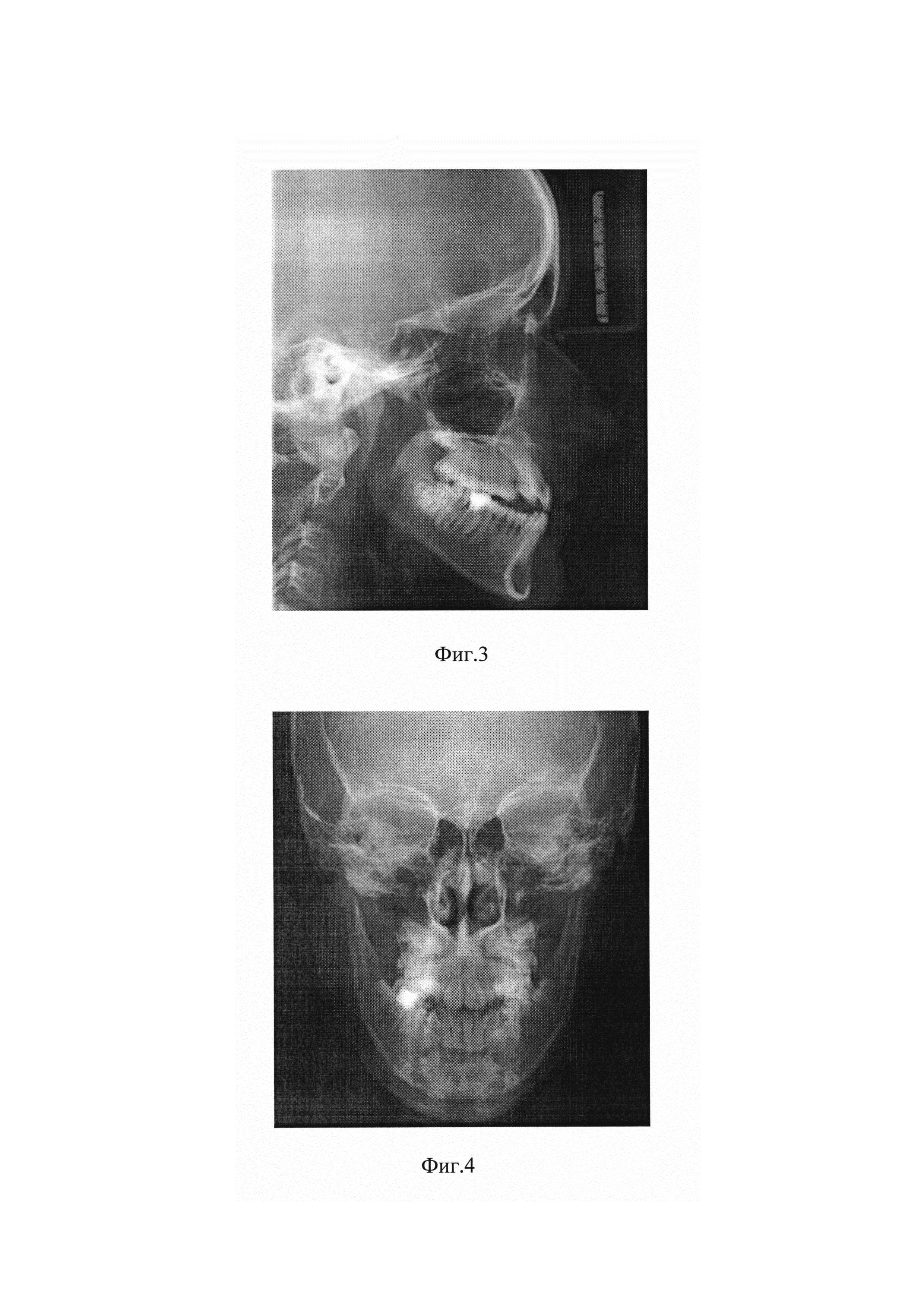 Способ лечения двустороннего перекрёстного прикуса у пациентов с сужением верхней челюсти