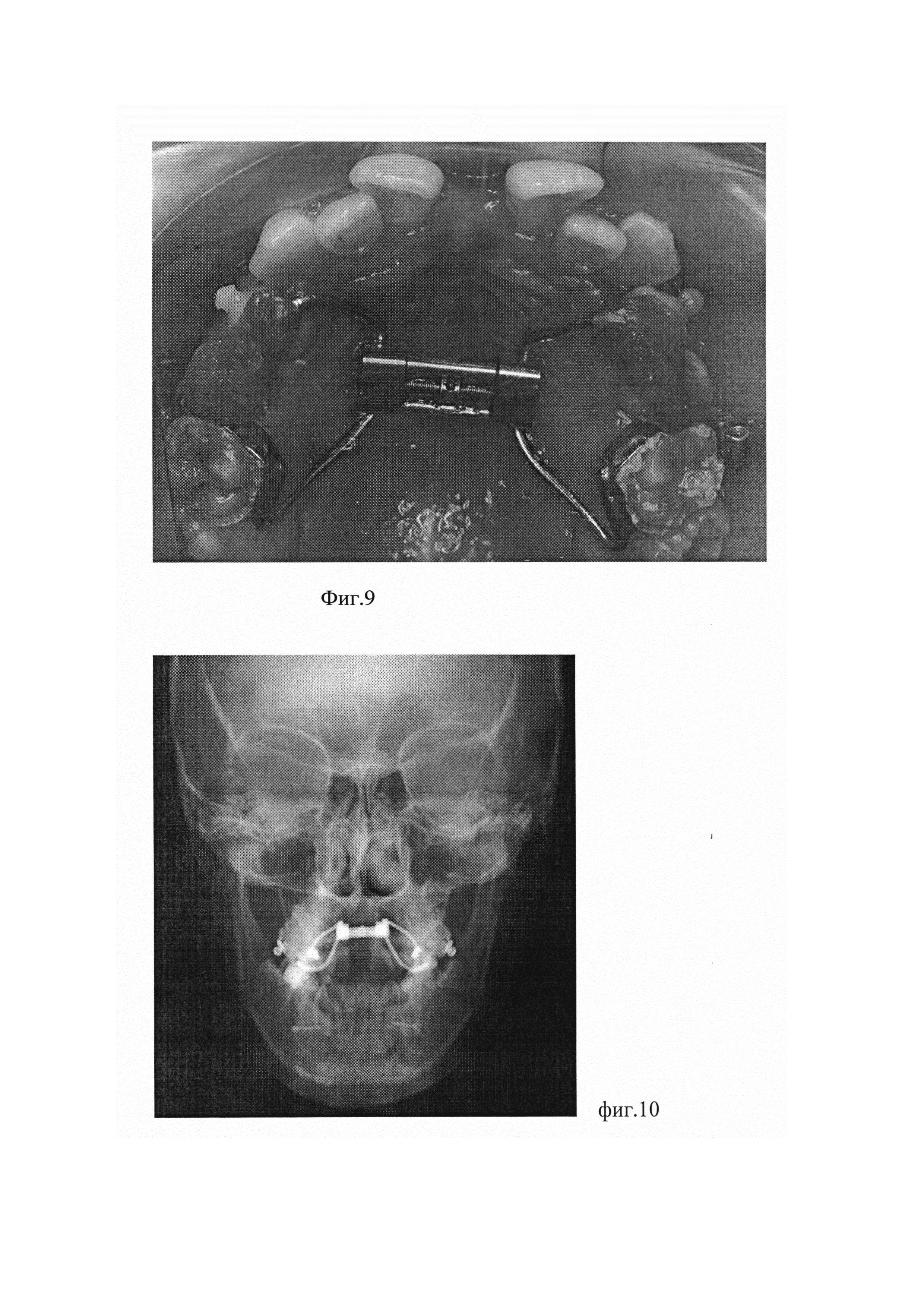 Способ лечения двустороннего перекрёстного прикуса у пациентов с сужением верхней челюсти