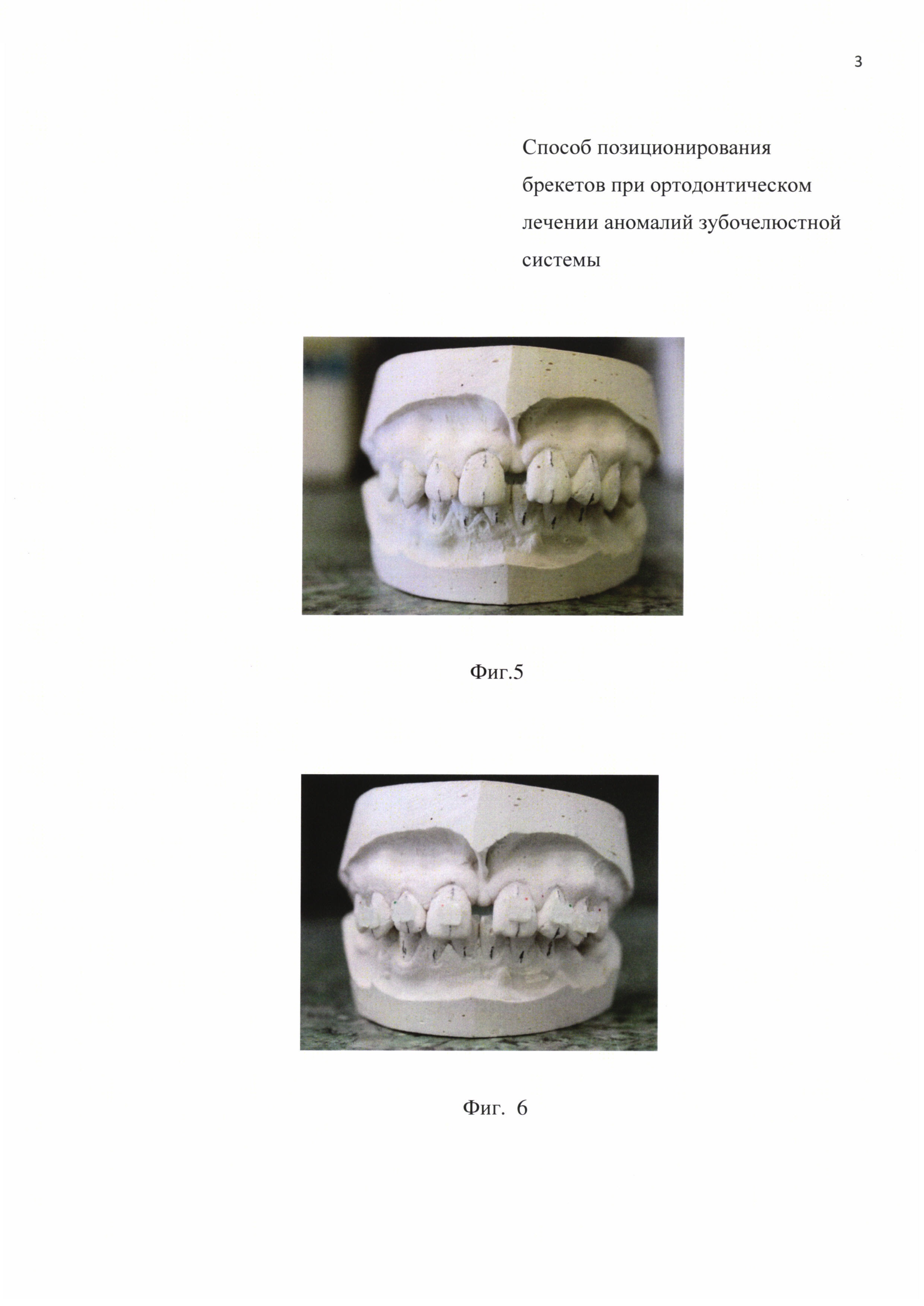 Способ позиционирования брекетов при ортодонтическом лечении аномалий зубочелюстной системы
