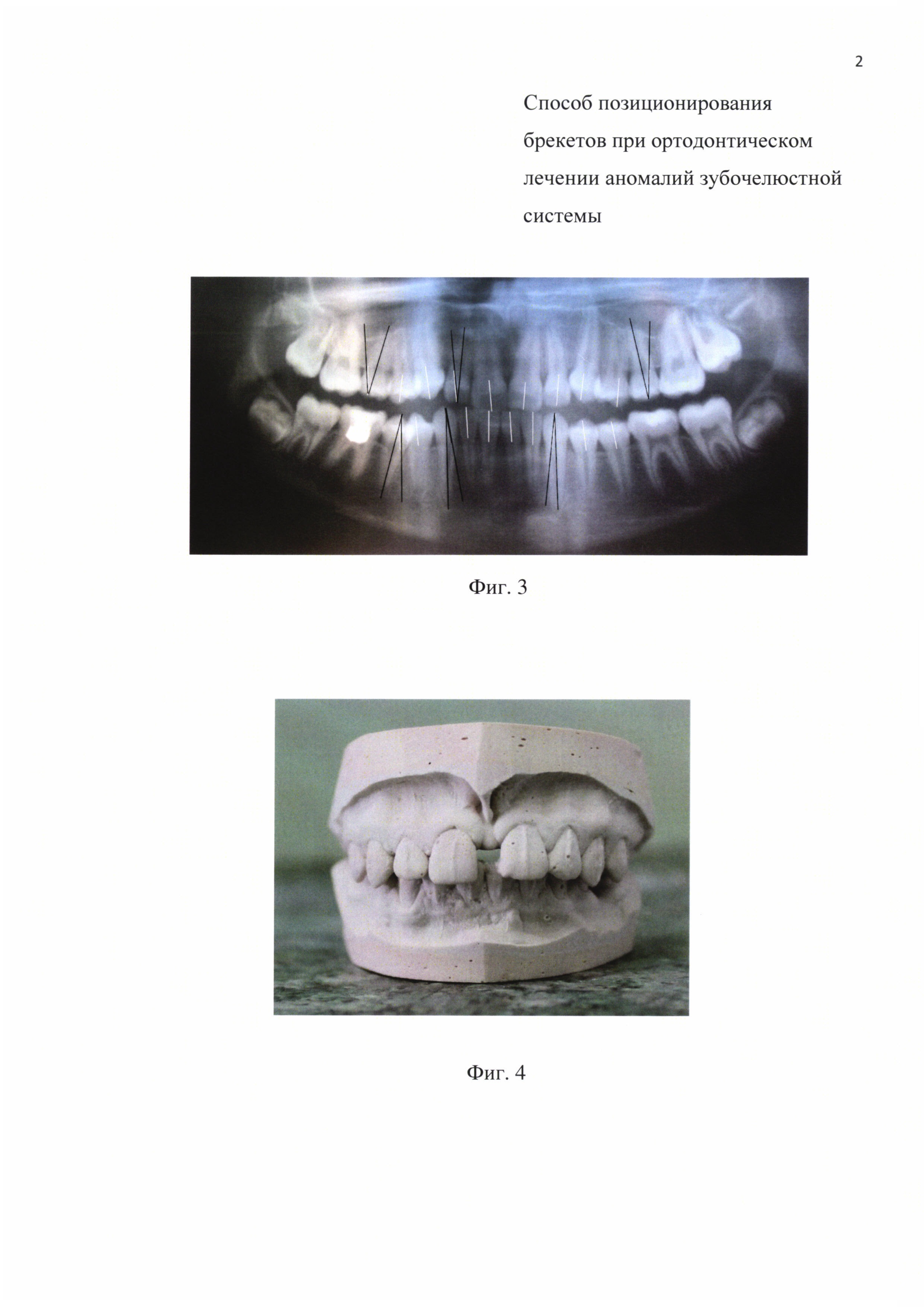 Способ позиционирования брекетов при ортодонтическом лечении аномалий зубочелюстной системы