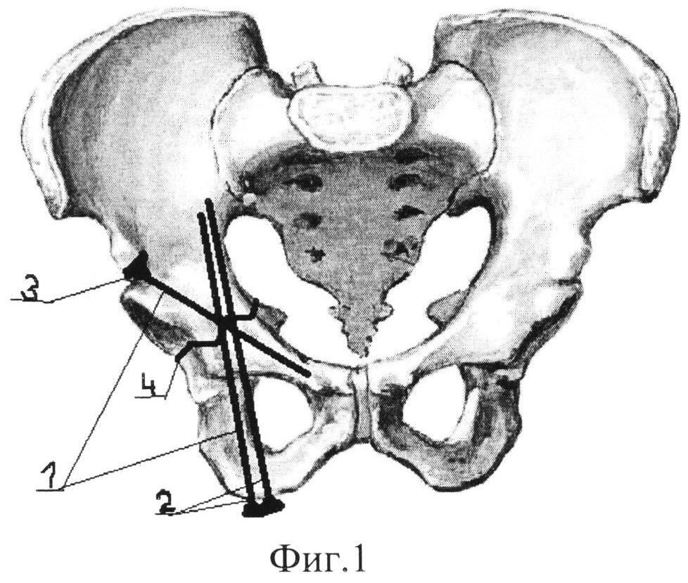 Подвздошная кость слева. Осколочный перелом вертлужной впадины. Перелом кости вертлужной впадины. Остеосинтез вертлужной впадины пластиной. Переломы костей таза, вертлужной впадины.