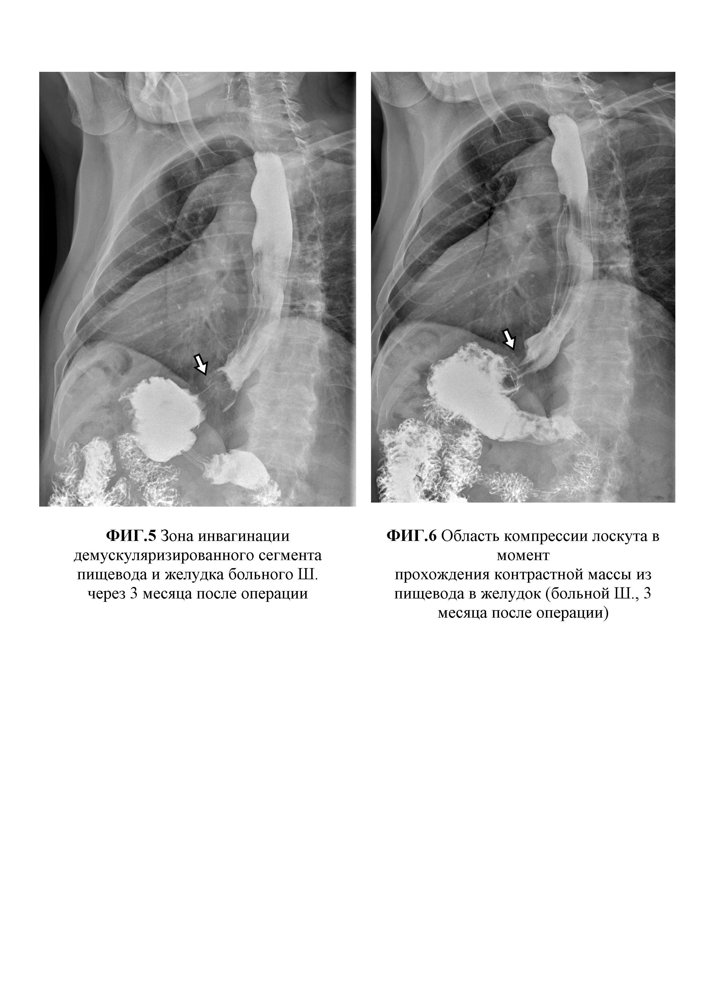 Способ хирургического лечения ахалазии кардии III-IV стадии, осложненной S-, L-образной деформацией пищевода