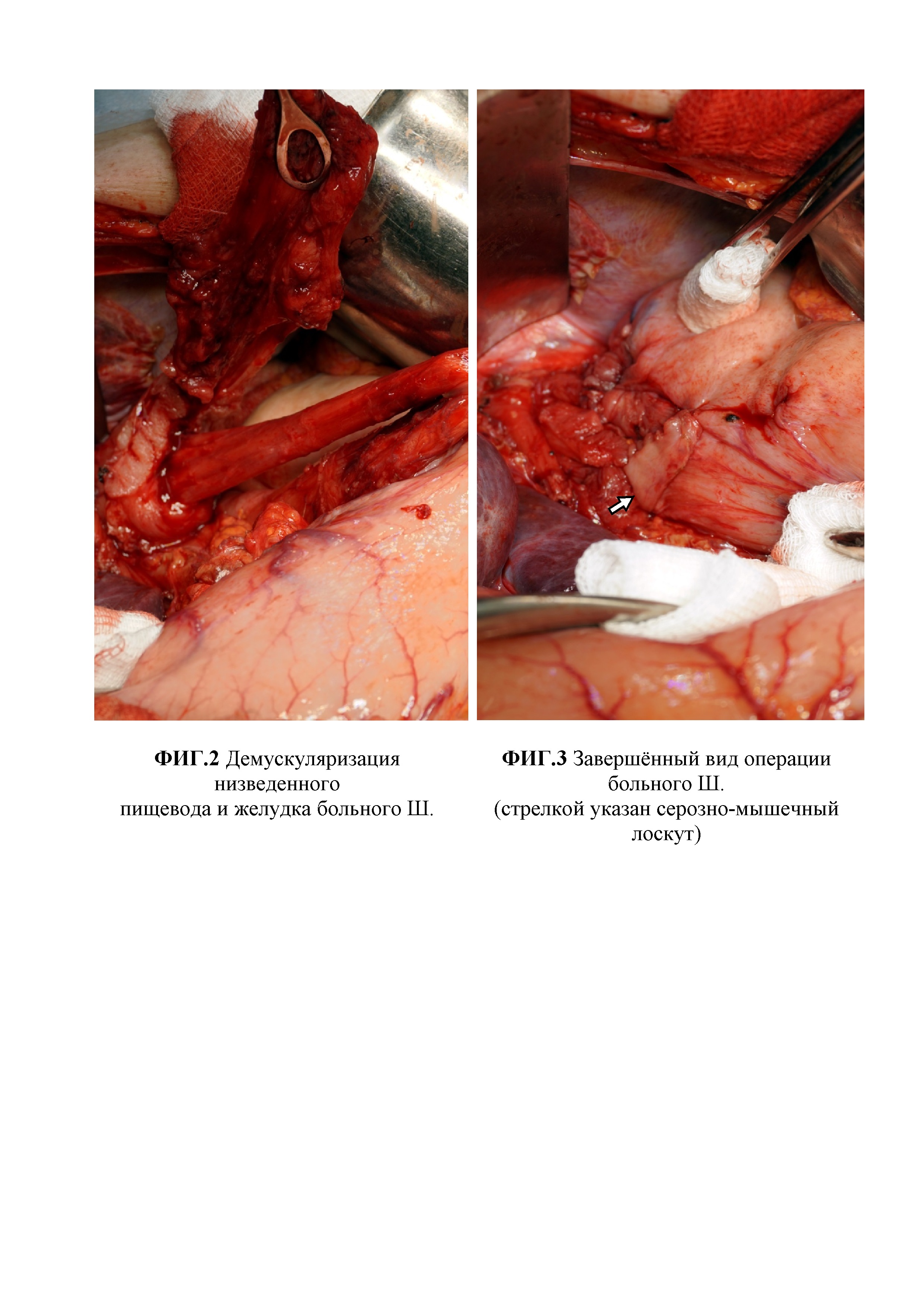 Способ хирургического лечения ахалазии кардии III-IV стадии, осложненной S-, L-образной деформацией пищевода