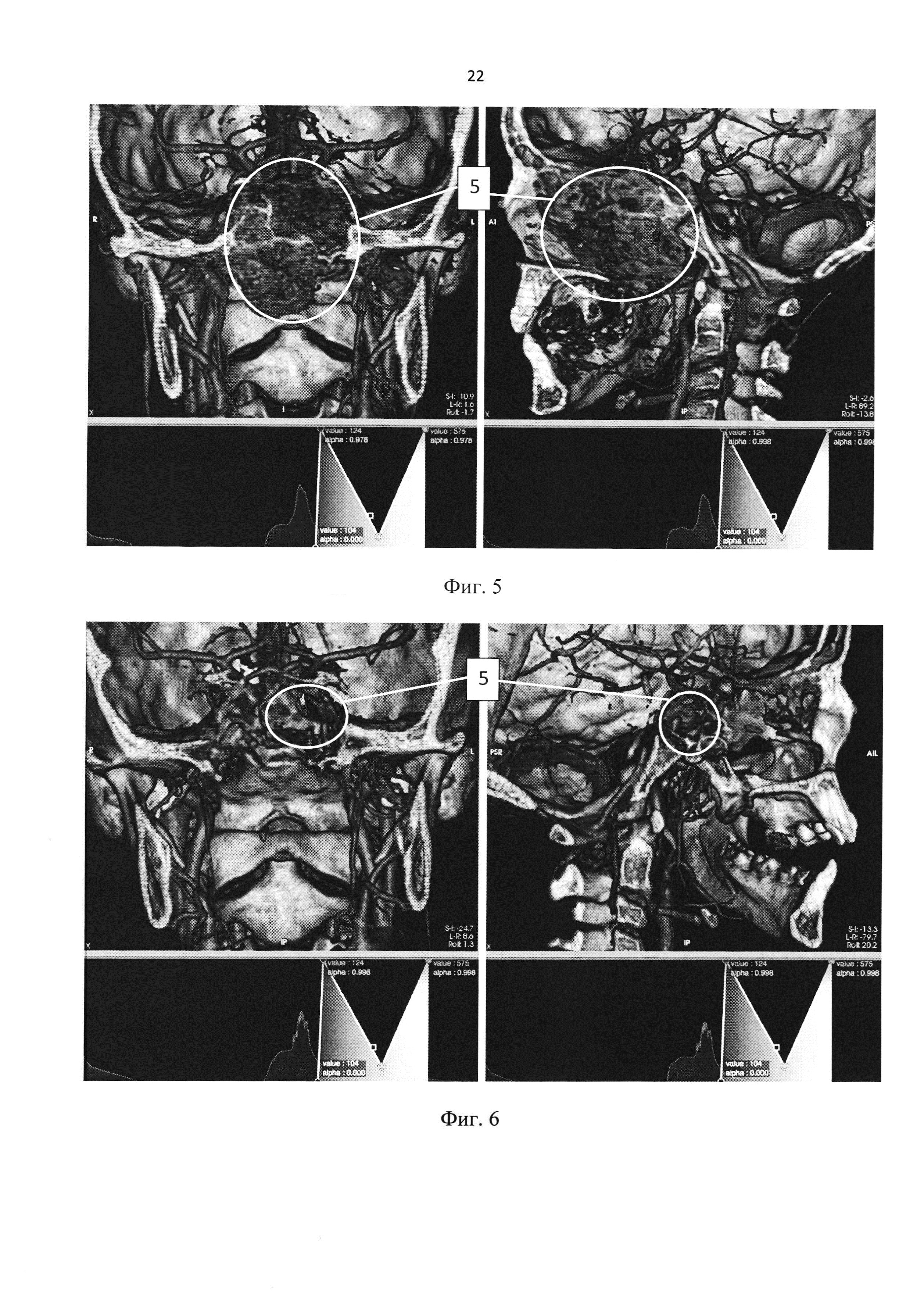 Способ визуализации результата хирургического лечения ювенильных ангиофибром носоглотки и основания черепа