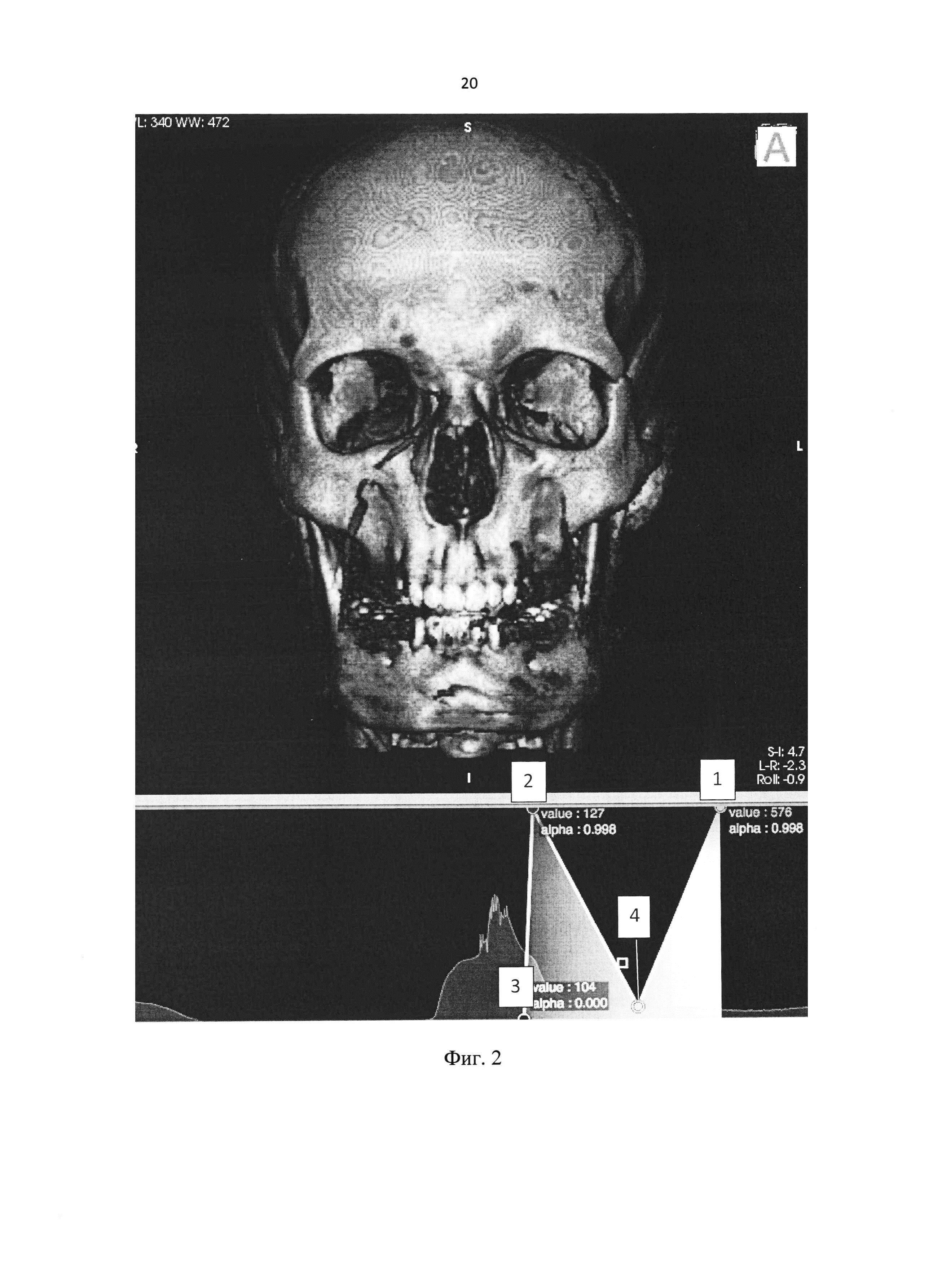 Способ визуализации результата хирургического лечения ювенильных ангиофибром носоглотки и основания черепа