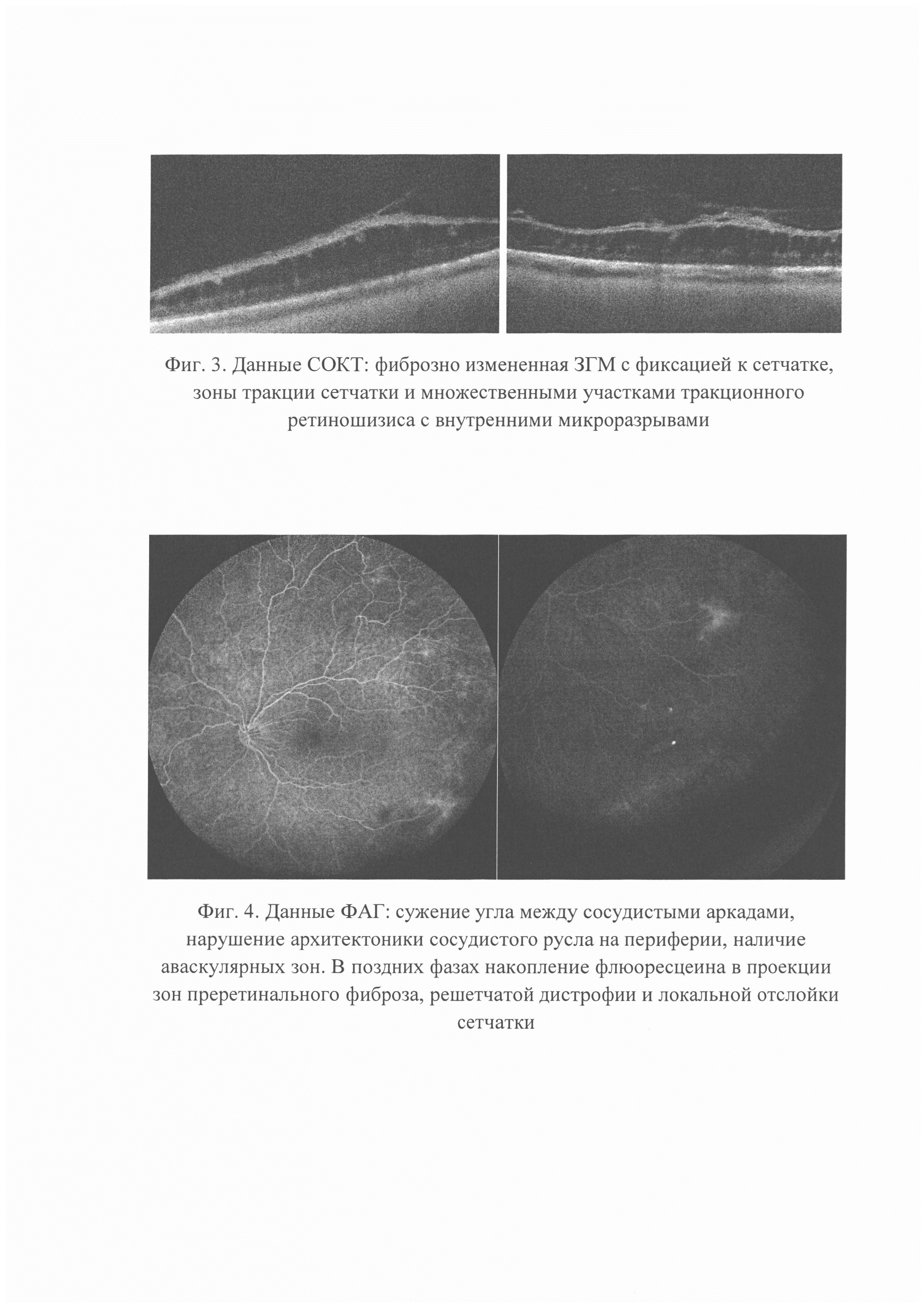 Способ прогнозирования риска разрывов сетчатки у детей с рубцовой ретинопатией недоношенных